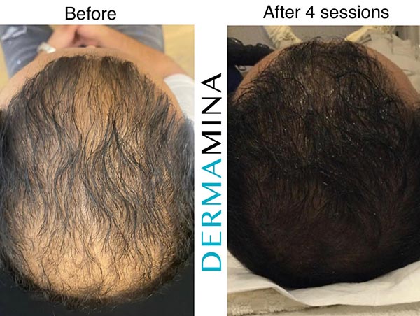 Prp Hair Restoration London Dermamina