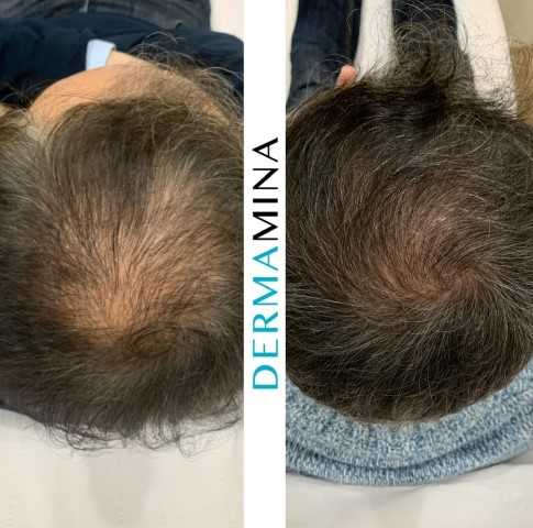 PRP Hair Treatment