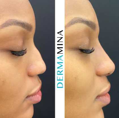 Pros And Cons Of Non Surgical Rhinoplasty Using Dermal Fillers Dermamina
