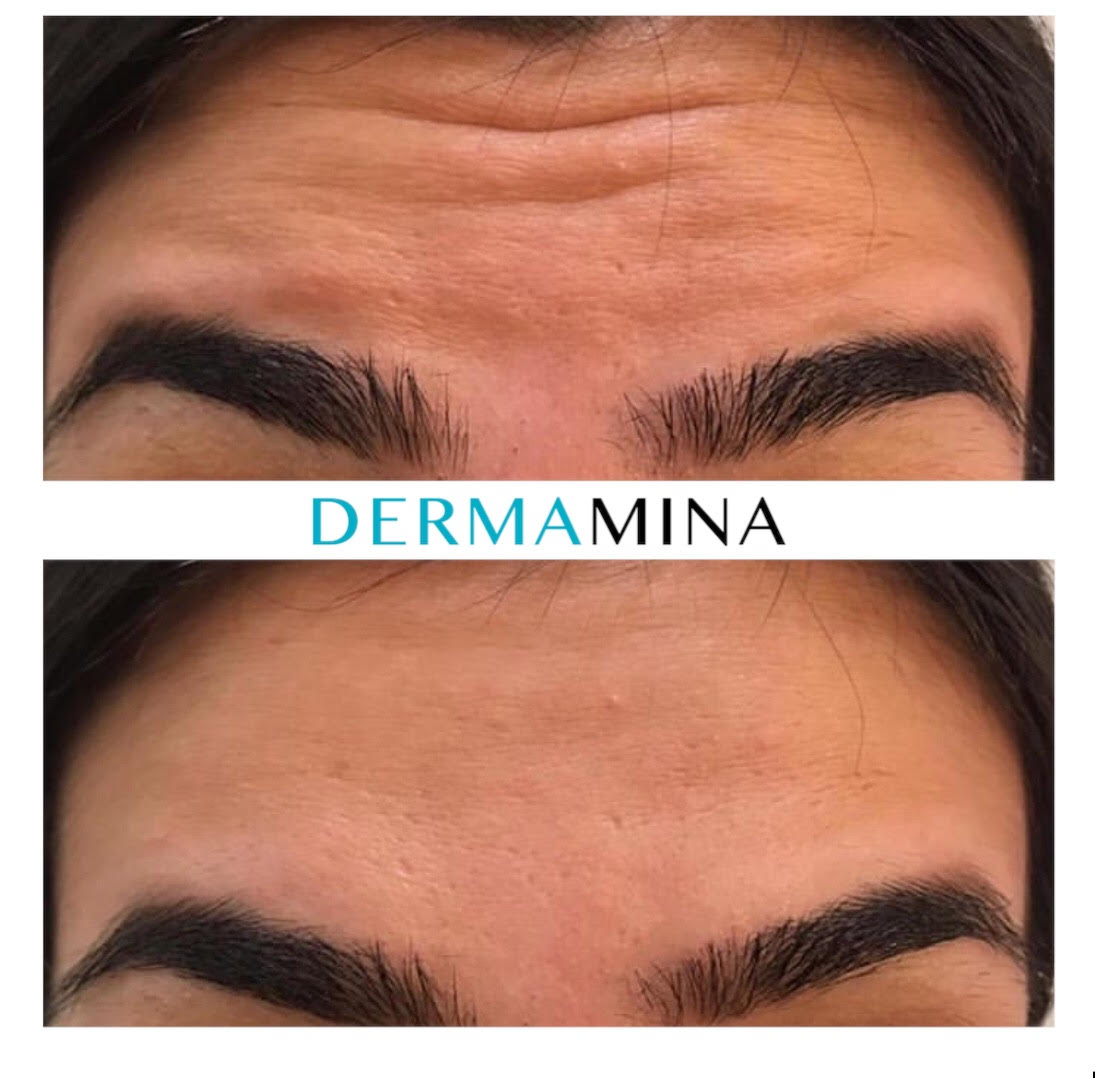 anti-Wrinkle before and after