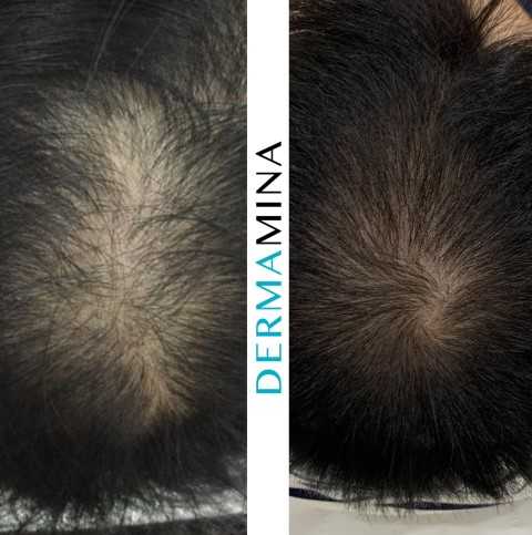 PRP Hair Treatment