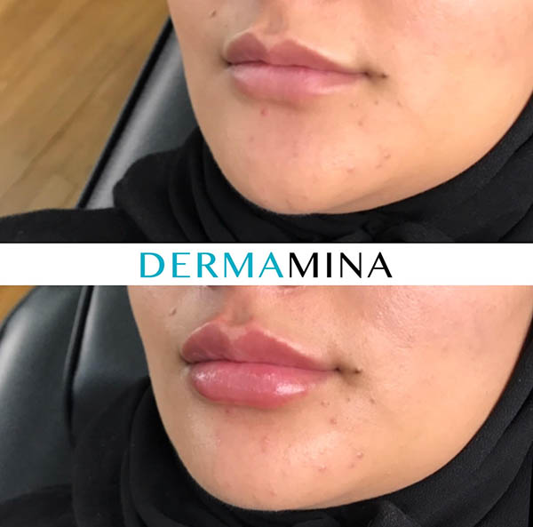 Lip Enhancement Before And After