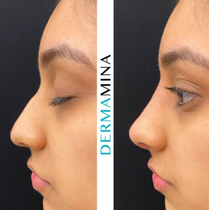 Nose Filler before and after