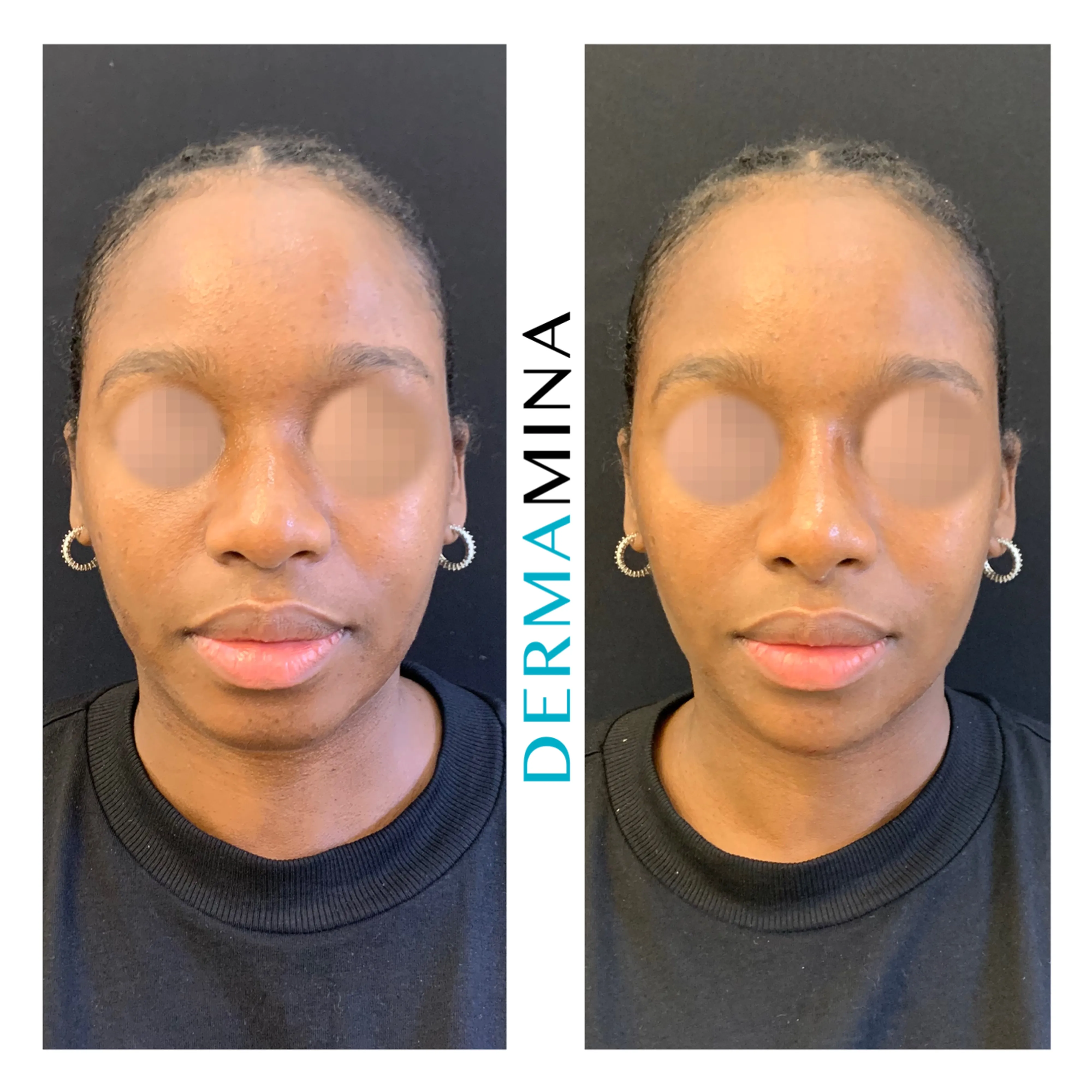 Non-surgical nose job before and after at Dermamina London, balanced, natural-looking profile