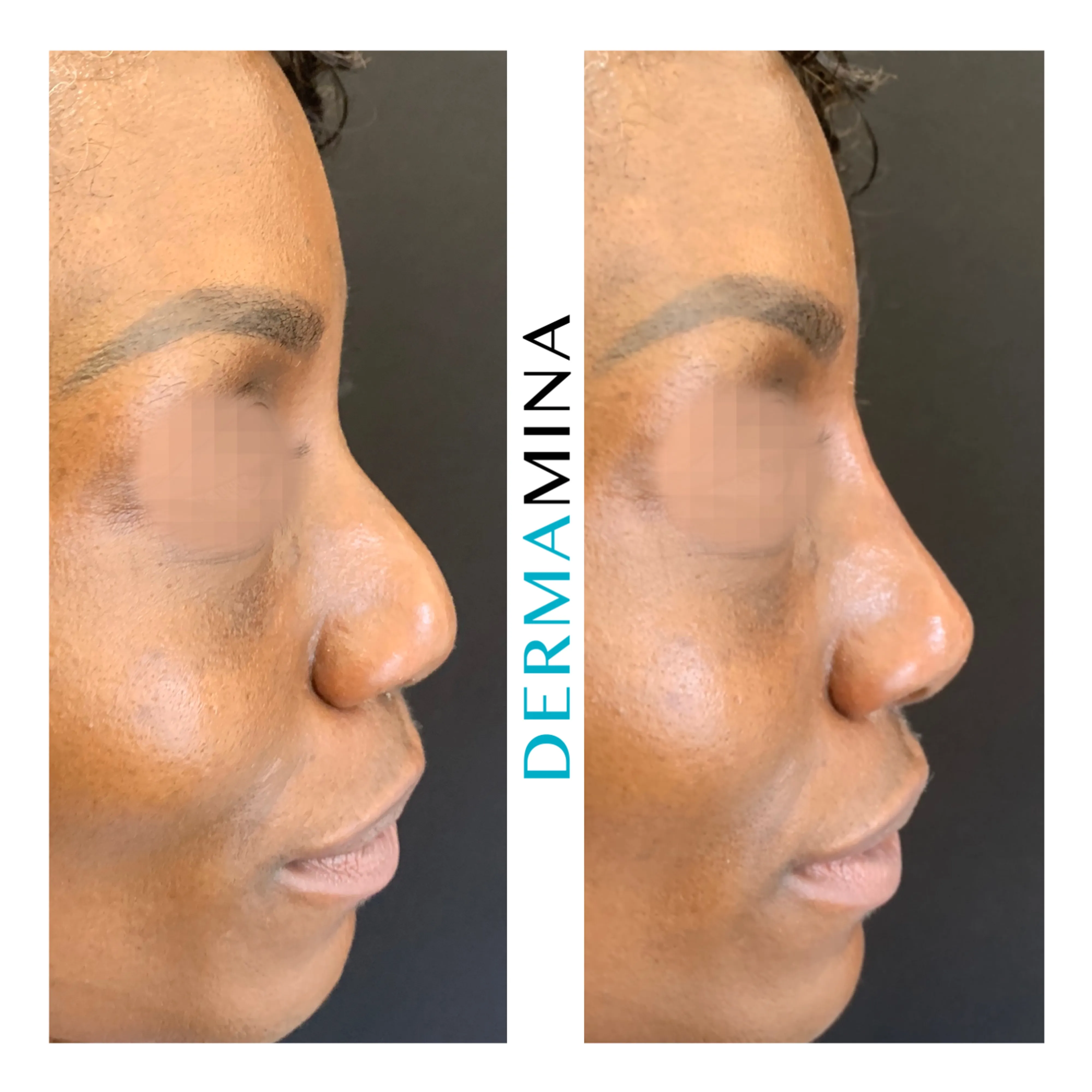 Non-surgical nose job before and after at Dermamina London, balanced, natural-looking profile