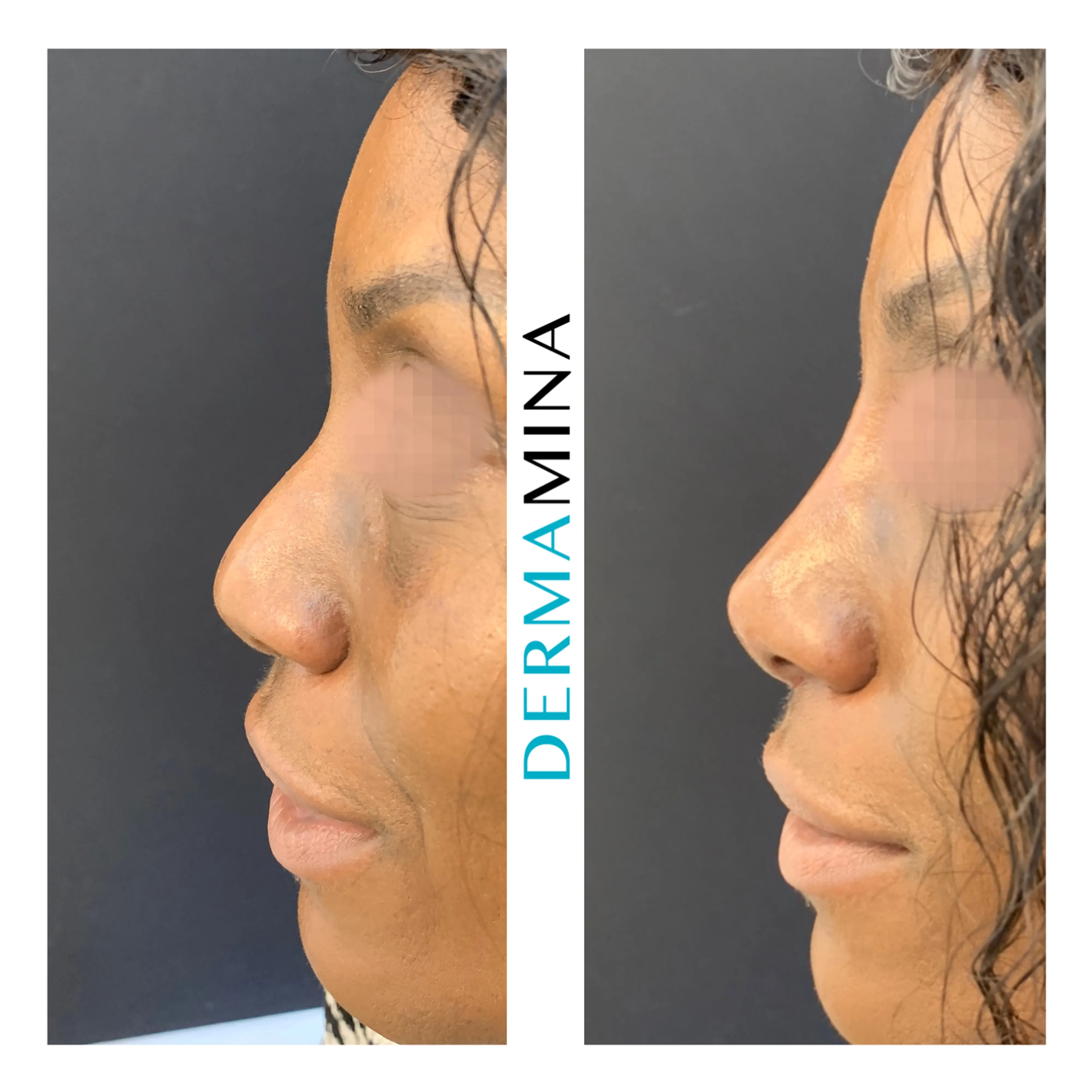 Non-surgical nose job before and after at Dermamina London, balanced, natural-looking profile