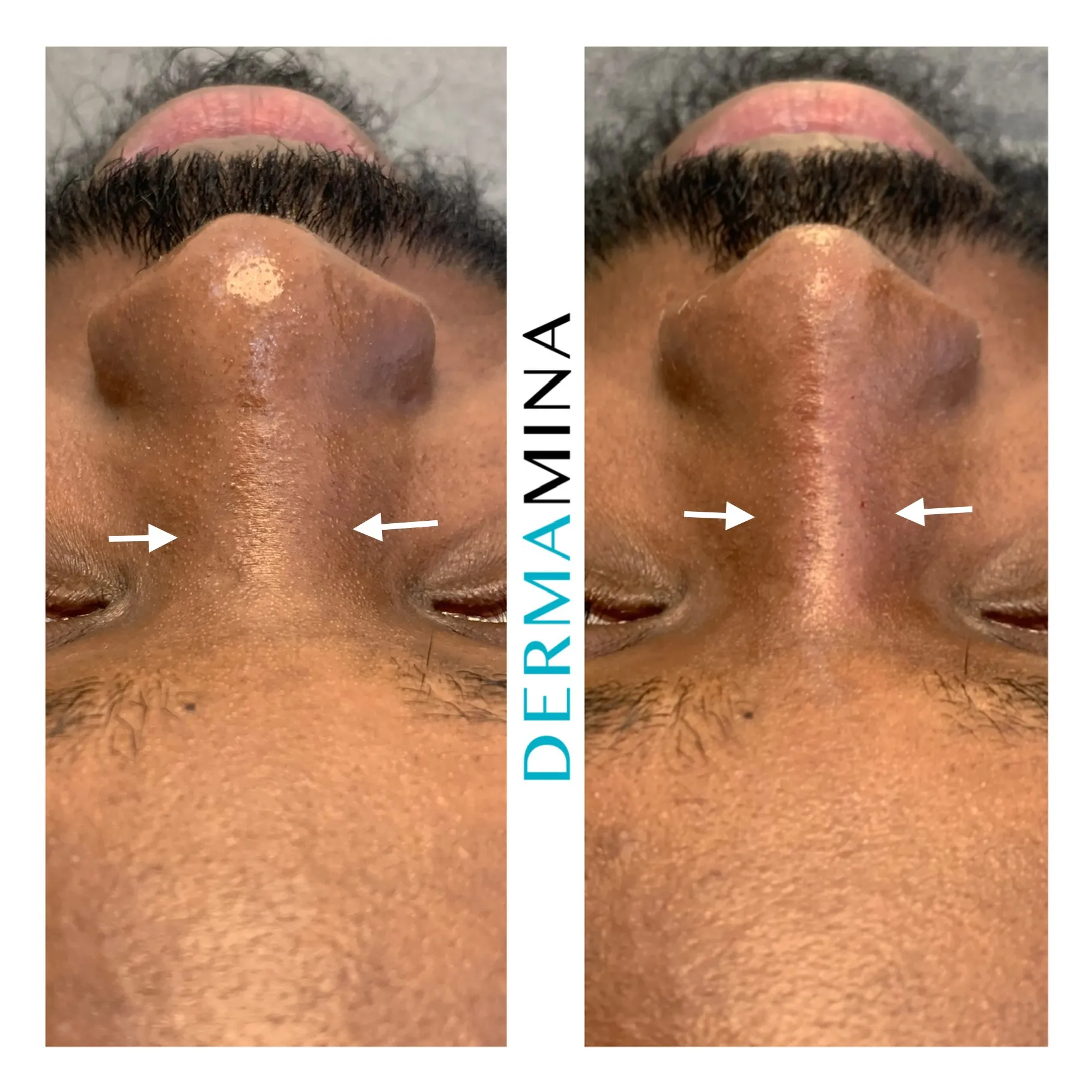 Non-surgical nose job before and after at Dermamina London, balanced, natural-looking profile