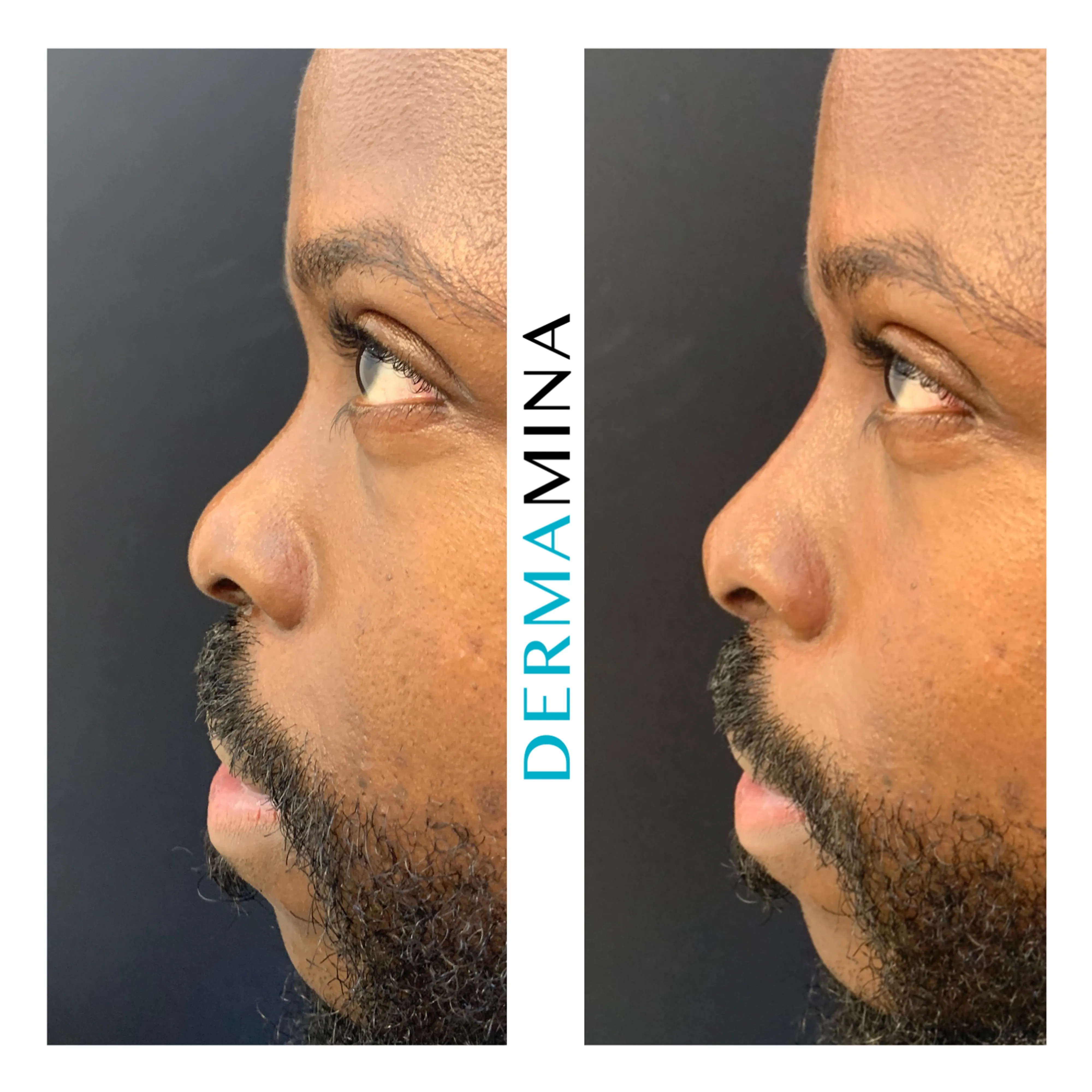 Non-surgical nose job before and after at Dermamina London, balanced, natural-looking profile