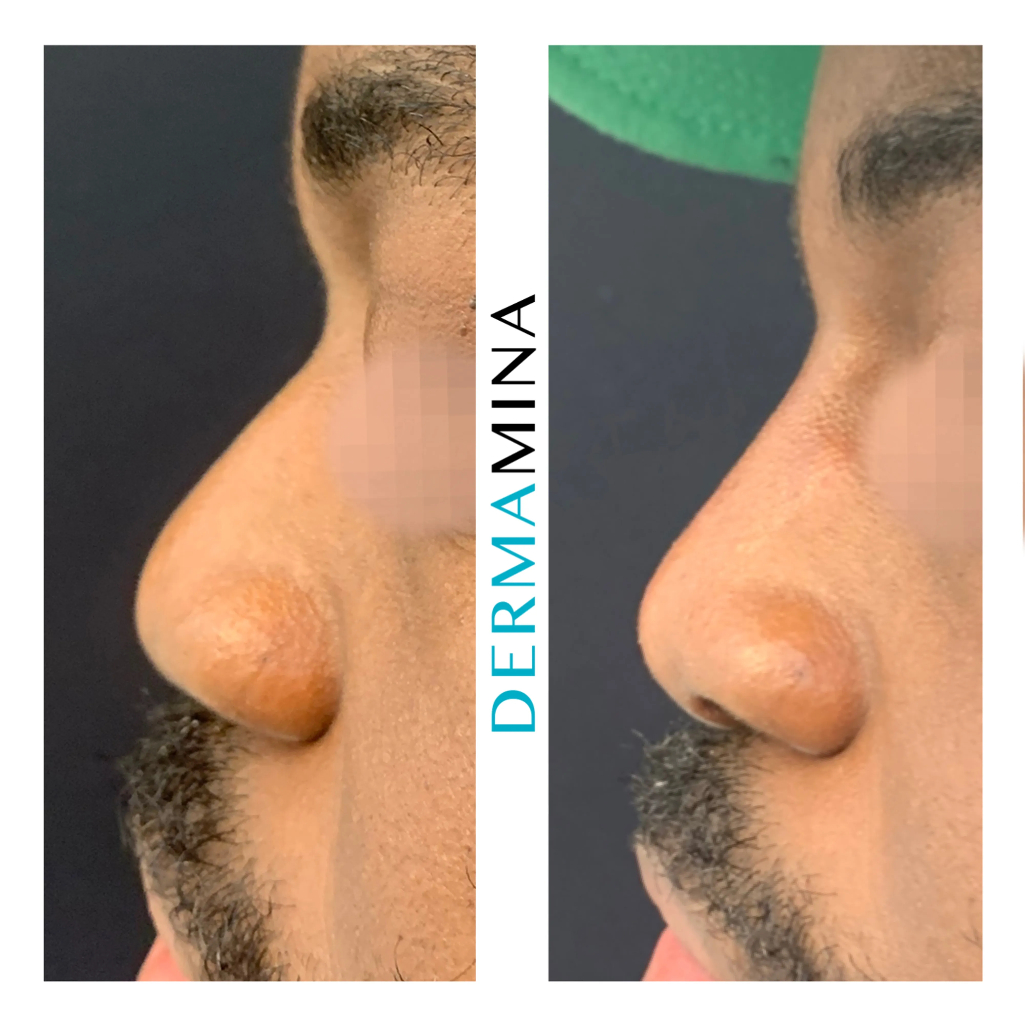 Non-surgical nose job before and after at Dermamina London, balanced, natural-looking profile