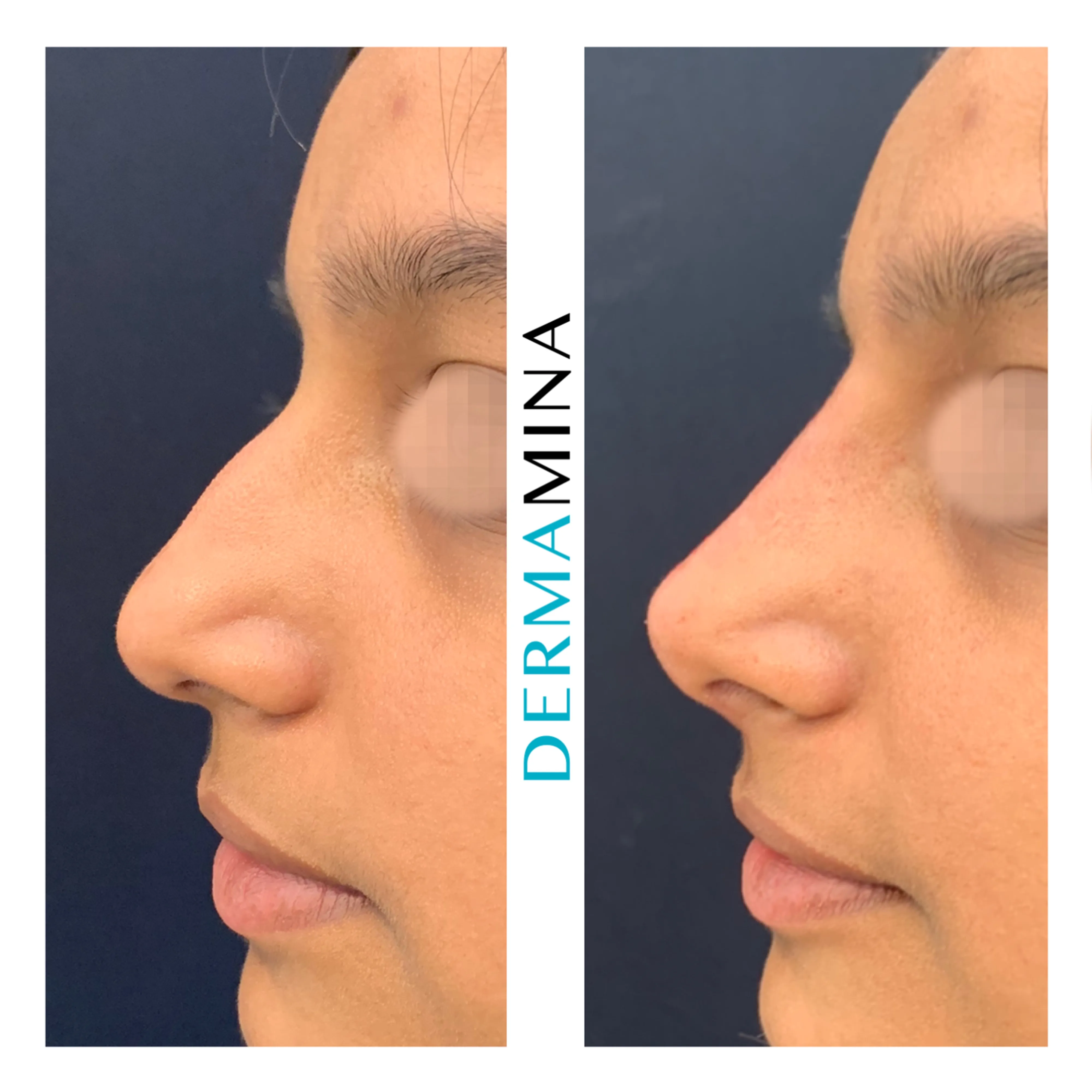 Non-surgical nose job before and after at Dermamina London, balanced, natural-looking profile