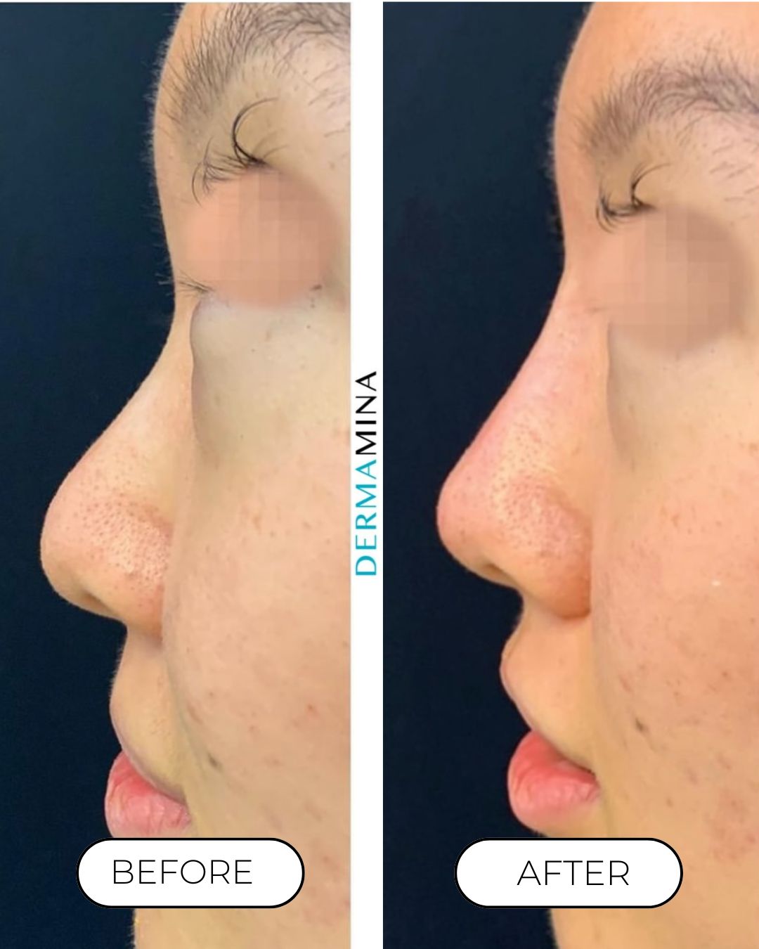 Non-surgical nose job before and after at Dermamina London, balanced, natural-looking profile