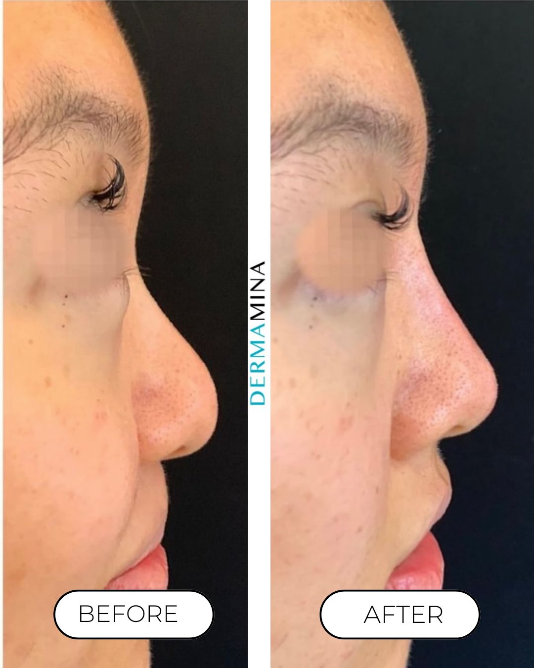 Non-surgical nose job before and after at Dermamina London, balanced, natural-looking profile