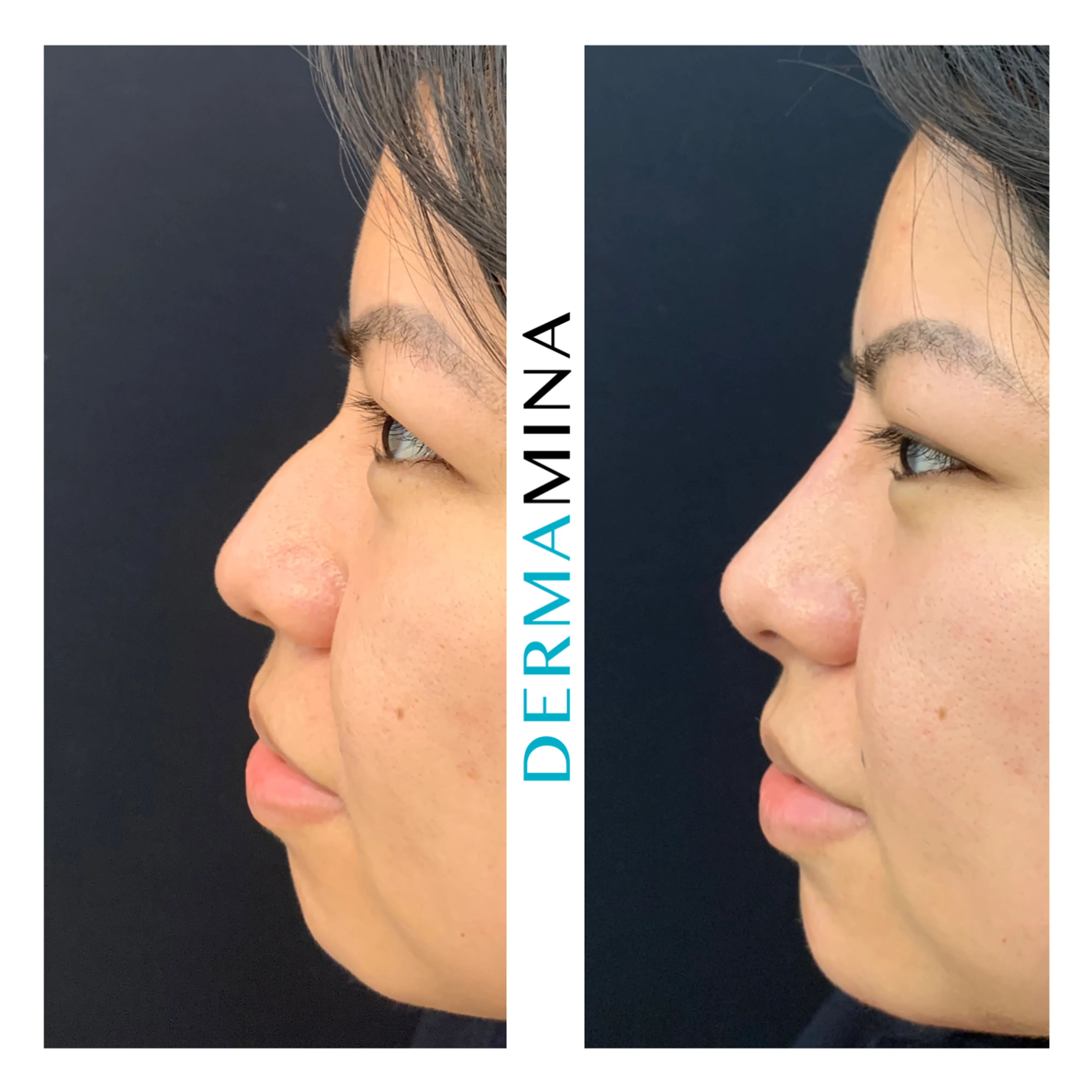 Non-surgical nose job before and after at Dermamina London, balanced, natural-looking profile