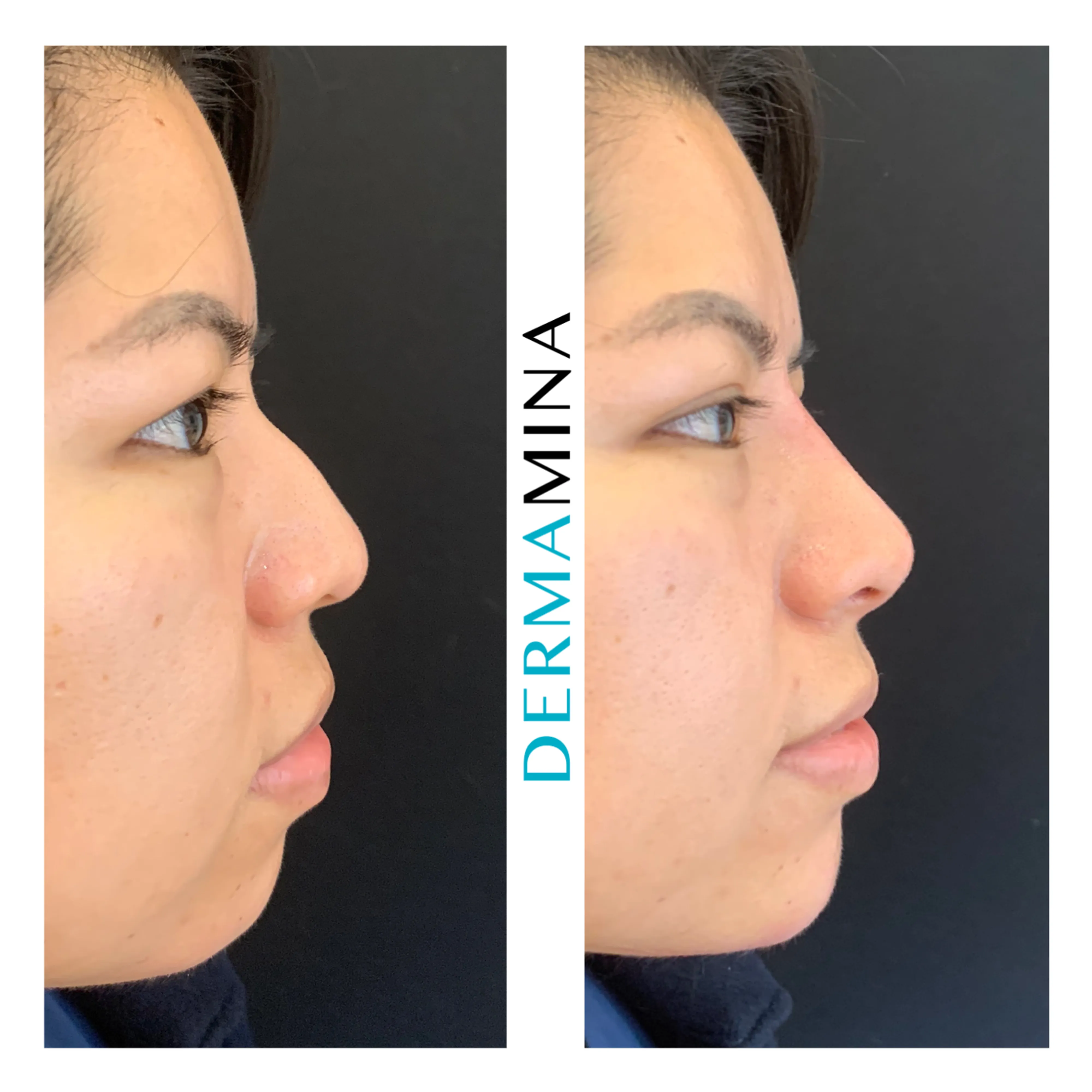 Non-surgical nose job before and after at Dermamina London, balanced, natural-looking profile