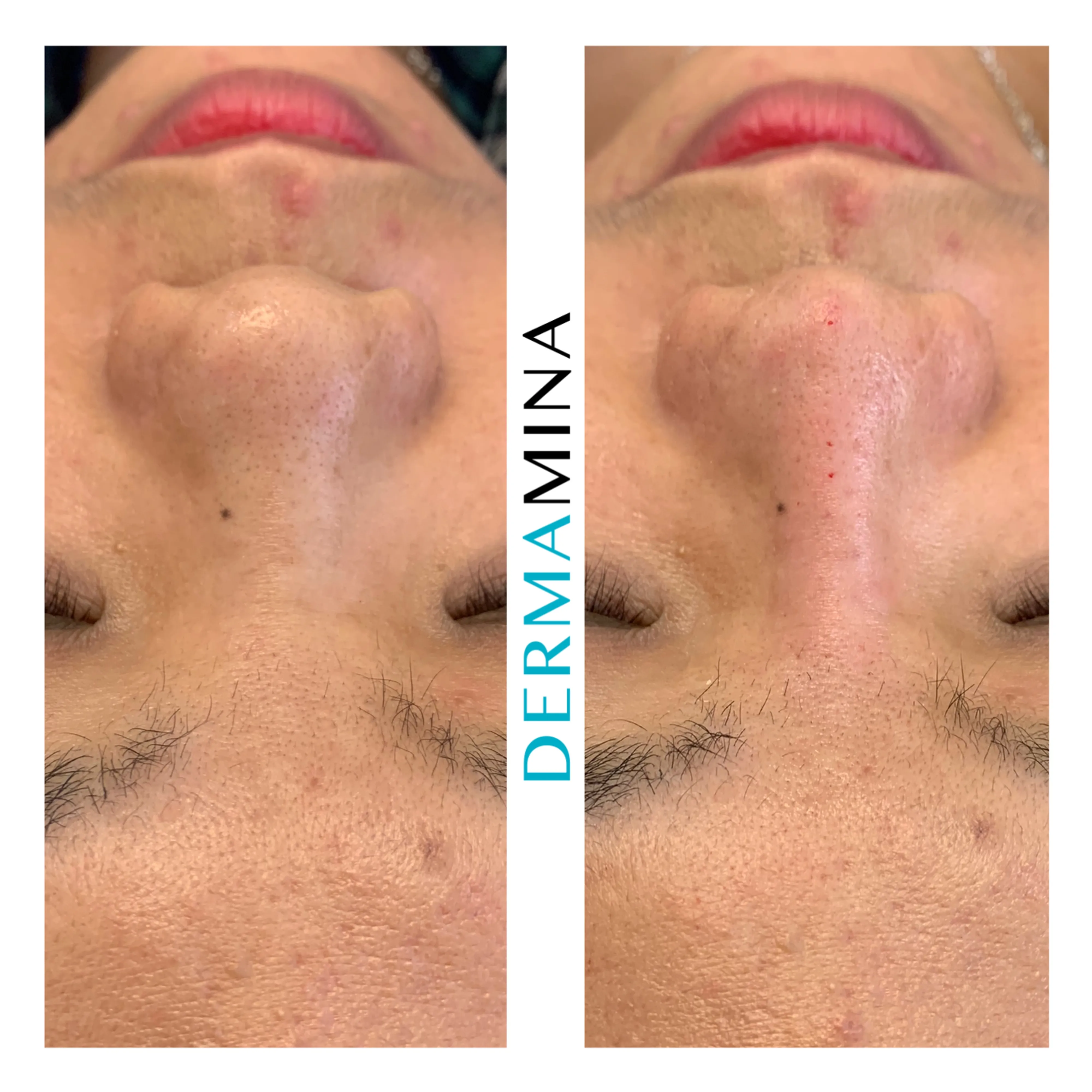 Non-surgical nose job before and after at Dermamina London, balanced, natural-looking profile