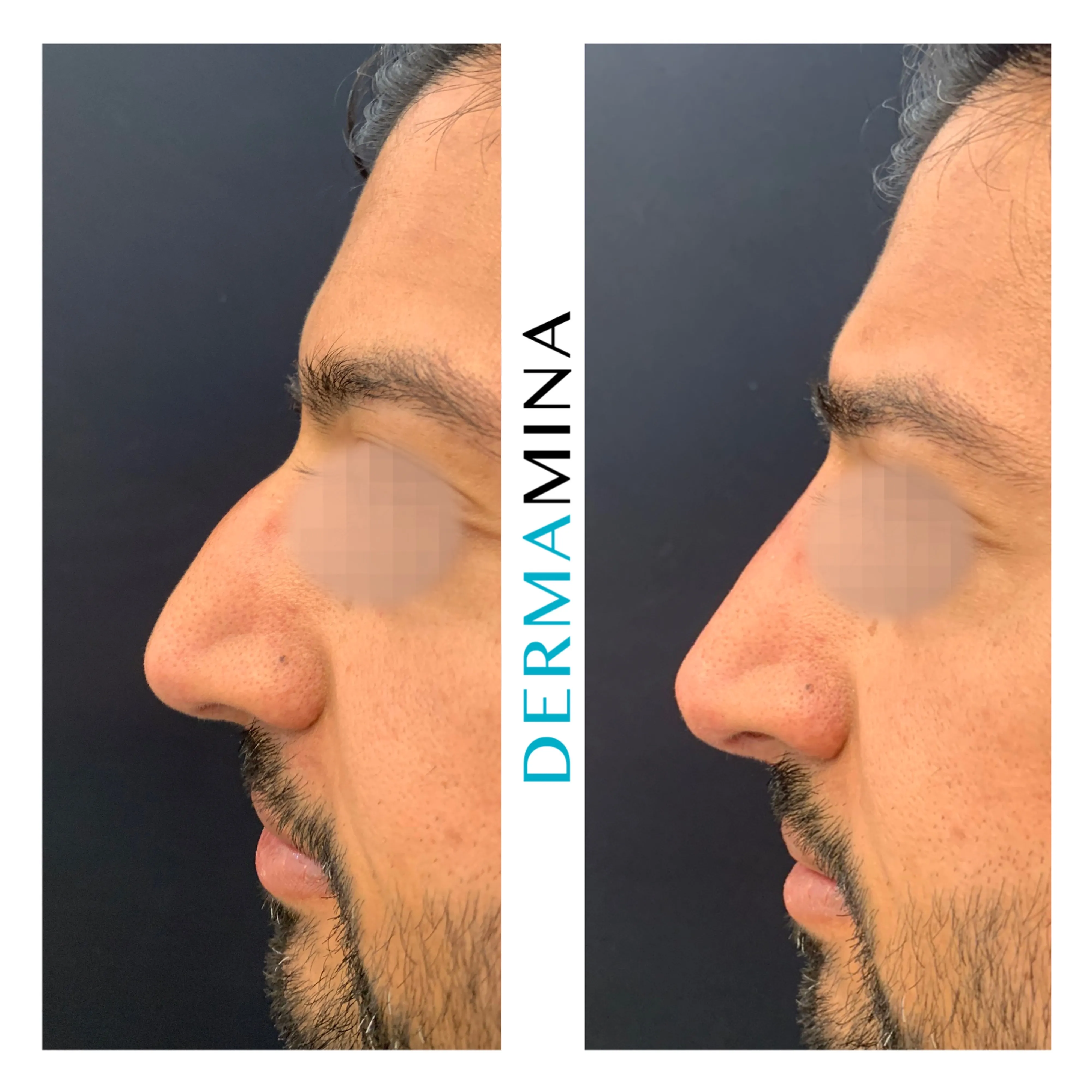 Non-surgical nose job before and after at Dermamina London, balanced, natural-looking profile