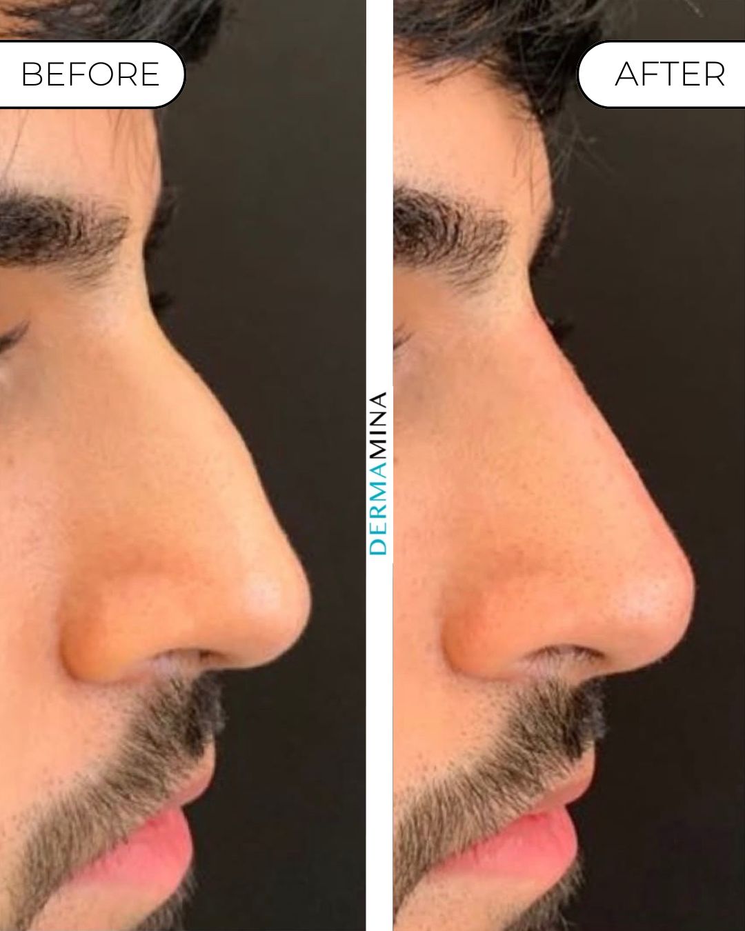 Non-surgical nose job before and after at Dermamina London, balanced, natural-looking profile