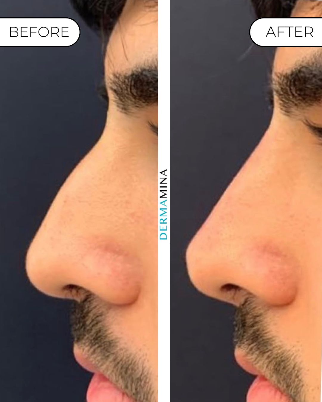 Non-surgical nose job before and after at Dermamina London, balanced, natural-looking profile