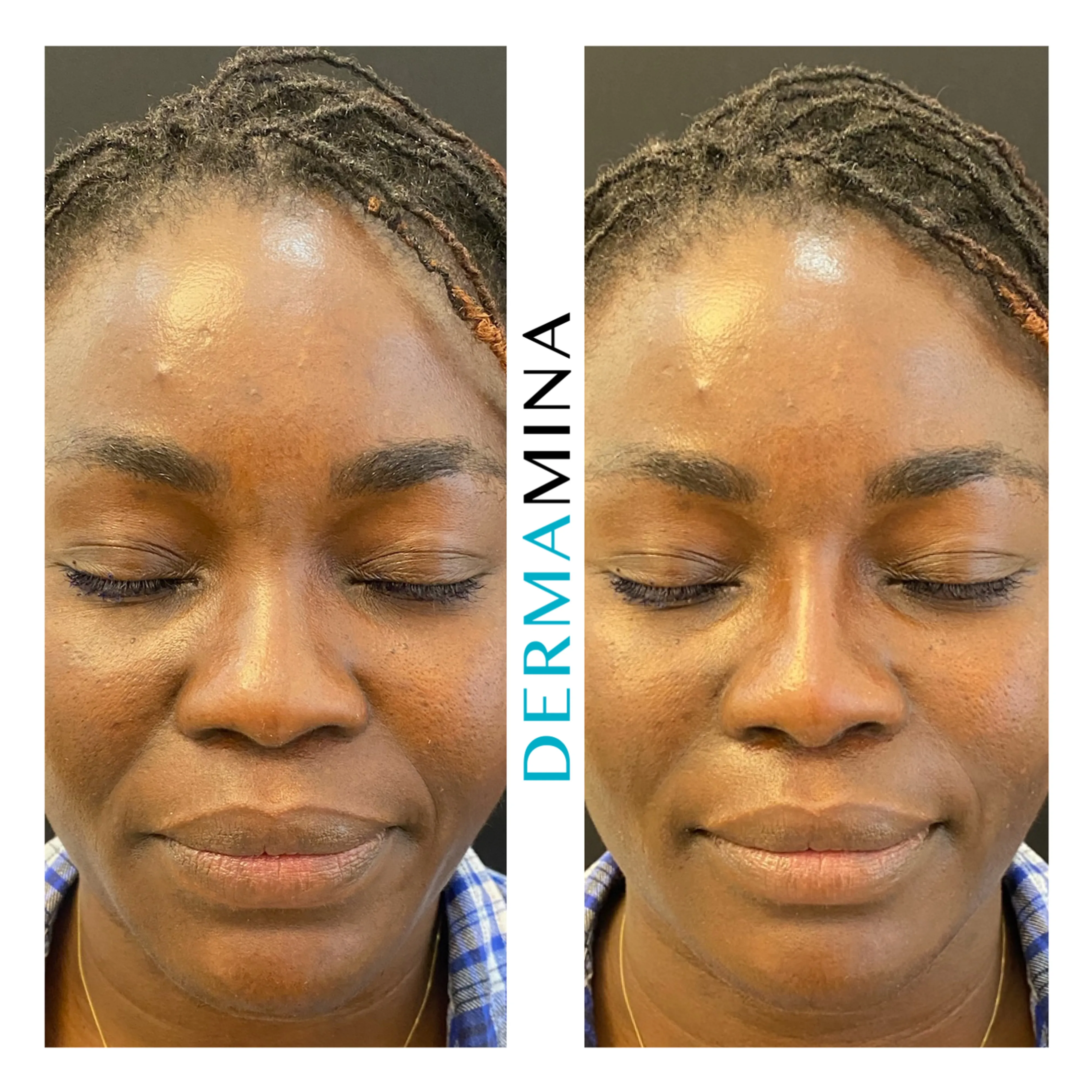 Non-surgical nose job before and after at Dermamina London, flat bridge built up and defined