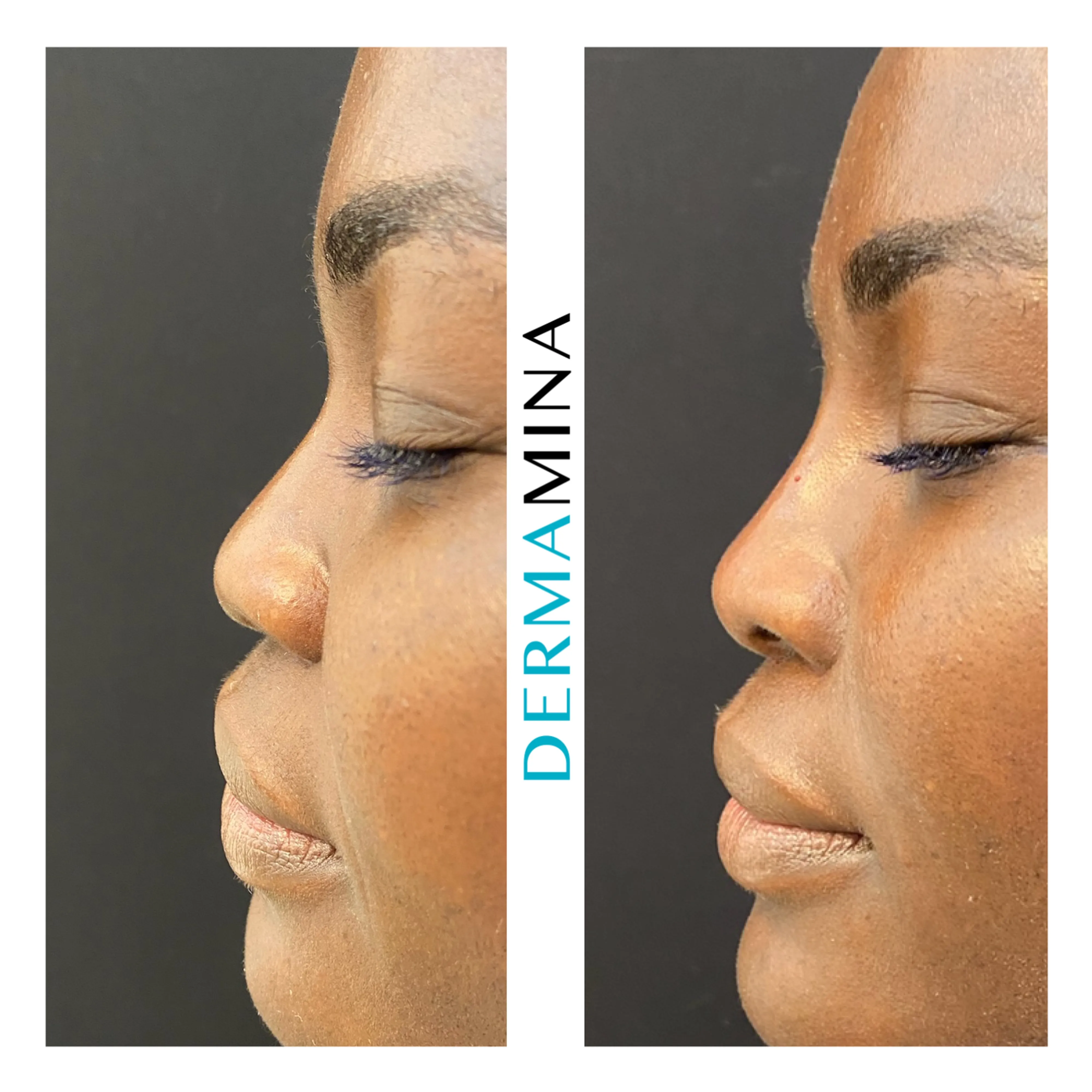 Non-surgical nose job before and after at Dermamina London, flat bridge built up and defined