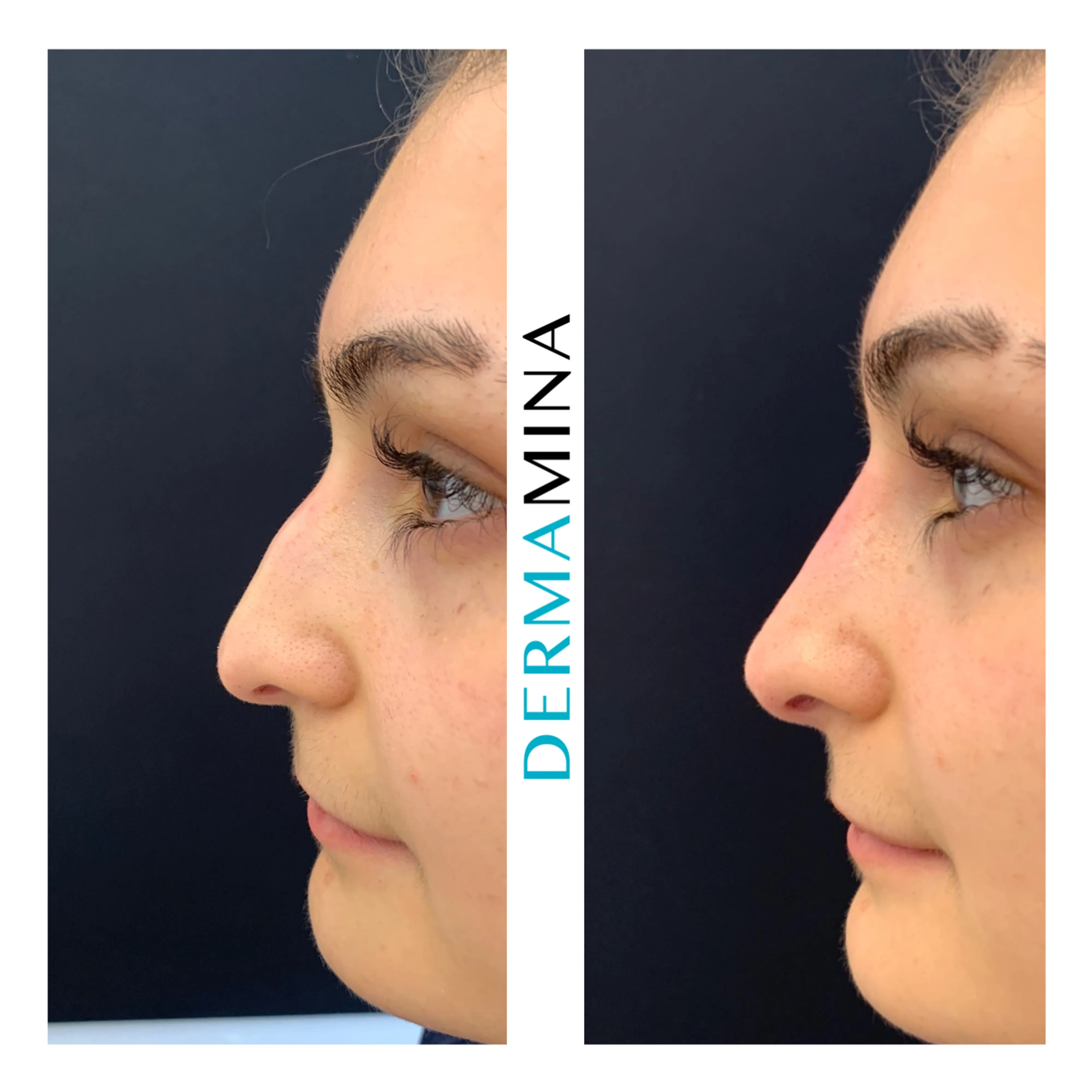 Non-surgical nose job before and after at Dermamina London, flat bridge built up and defined