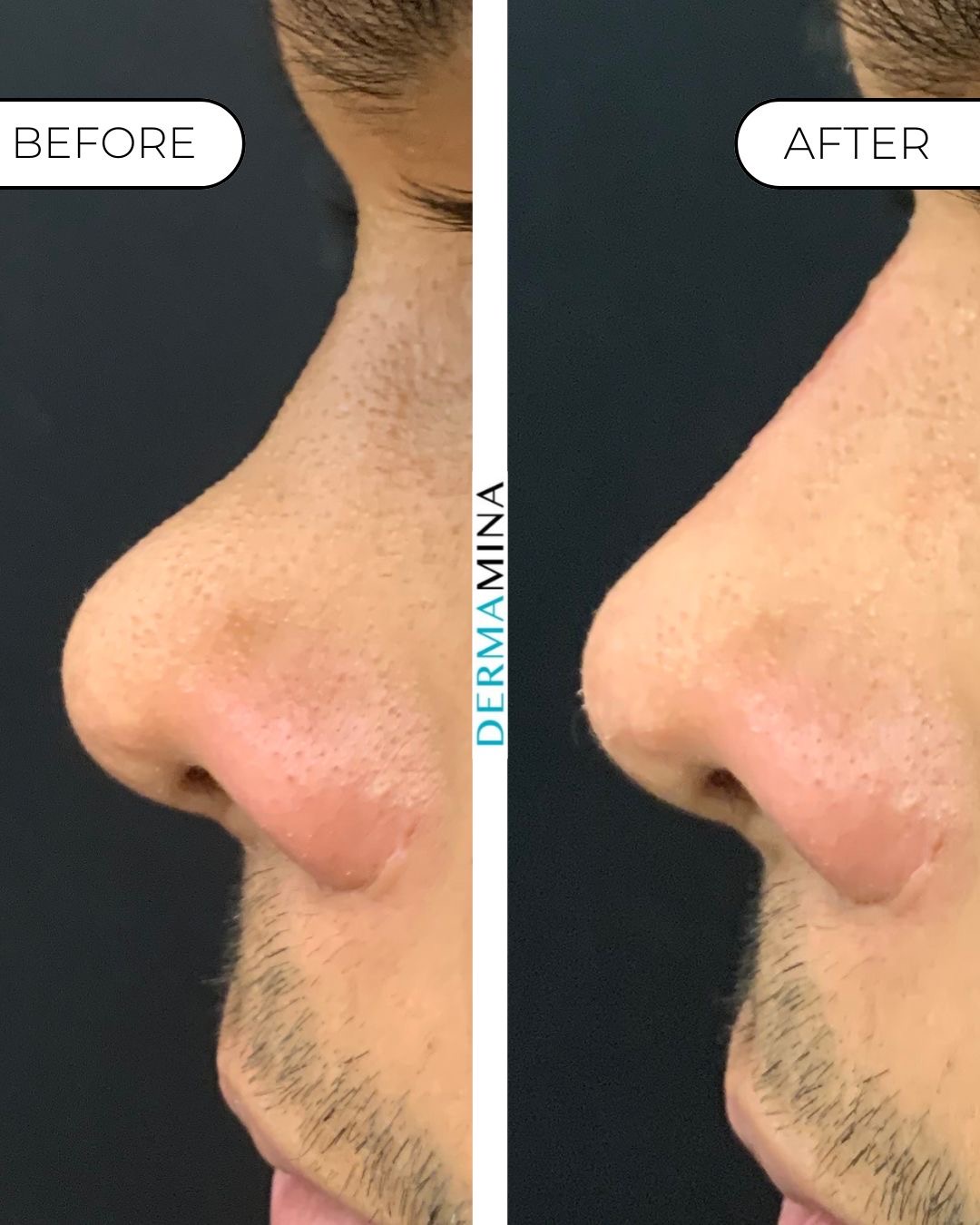 Non-surgical nose job before and after at Dermamina London, flat bridge built up and defined