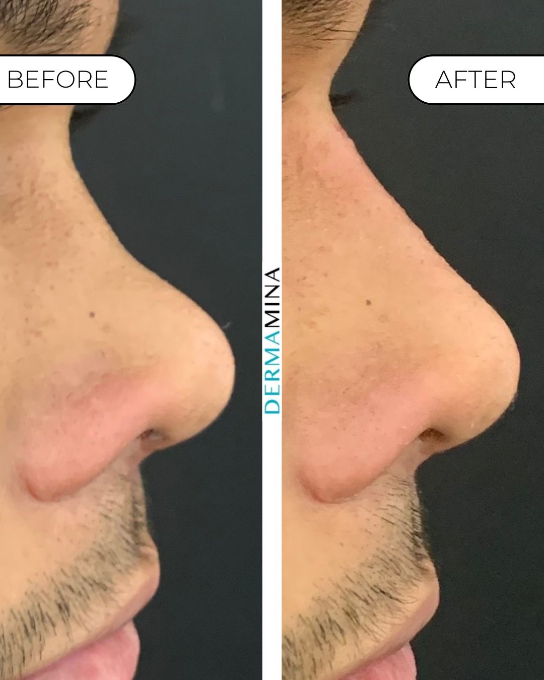 Non-surgical nose job before and after at Dermamina London, flat bridge built up and defined