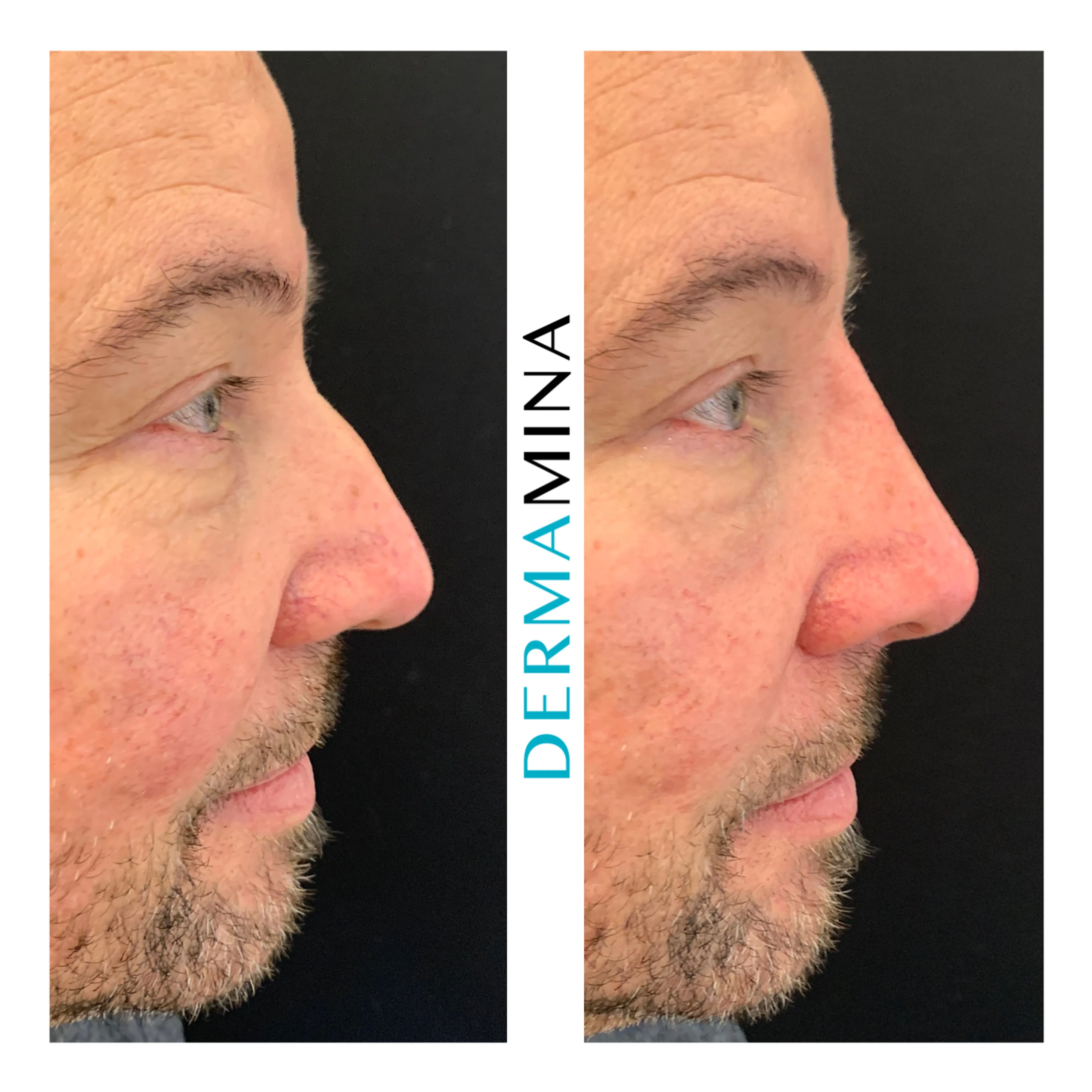 Non-surgical nose job before and after at Dermamina London, flat bridge built up and defined