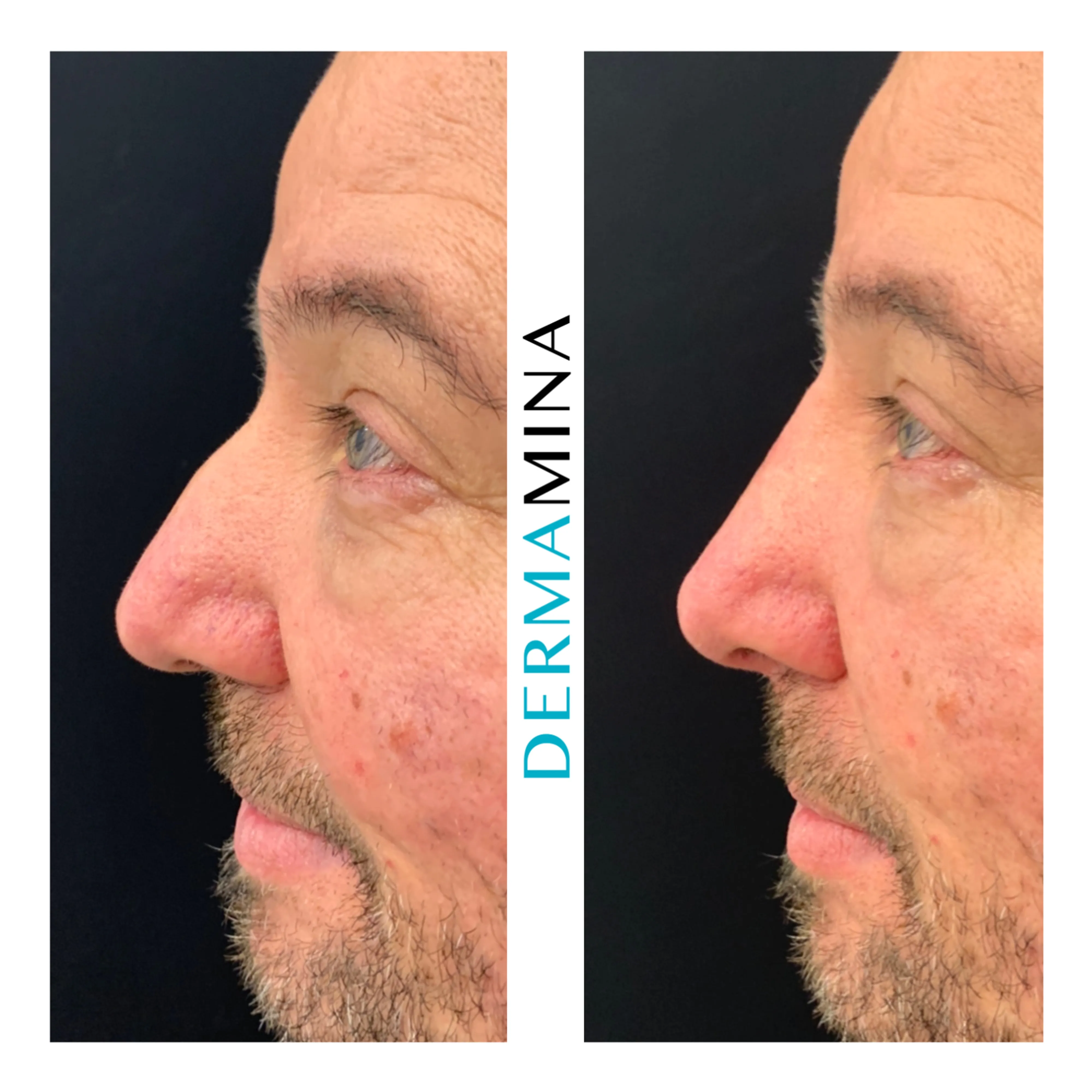 Non-surgical nose job before and after at Dermamina London, flat bridge built up and defined