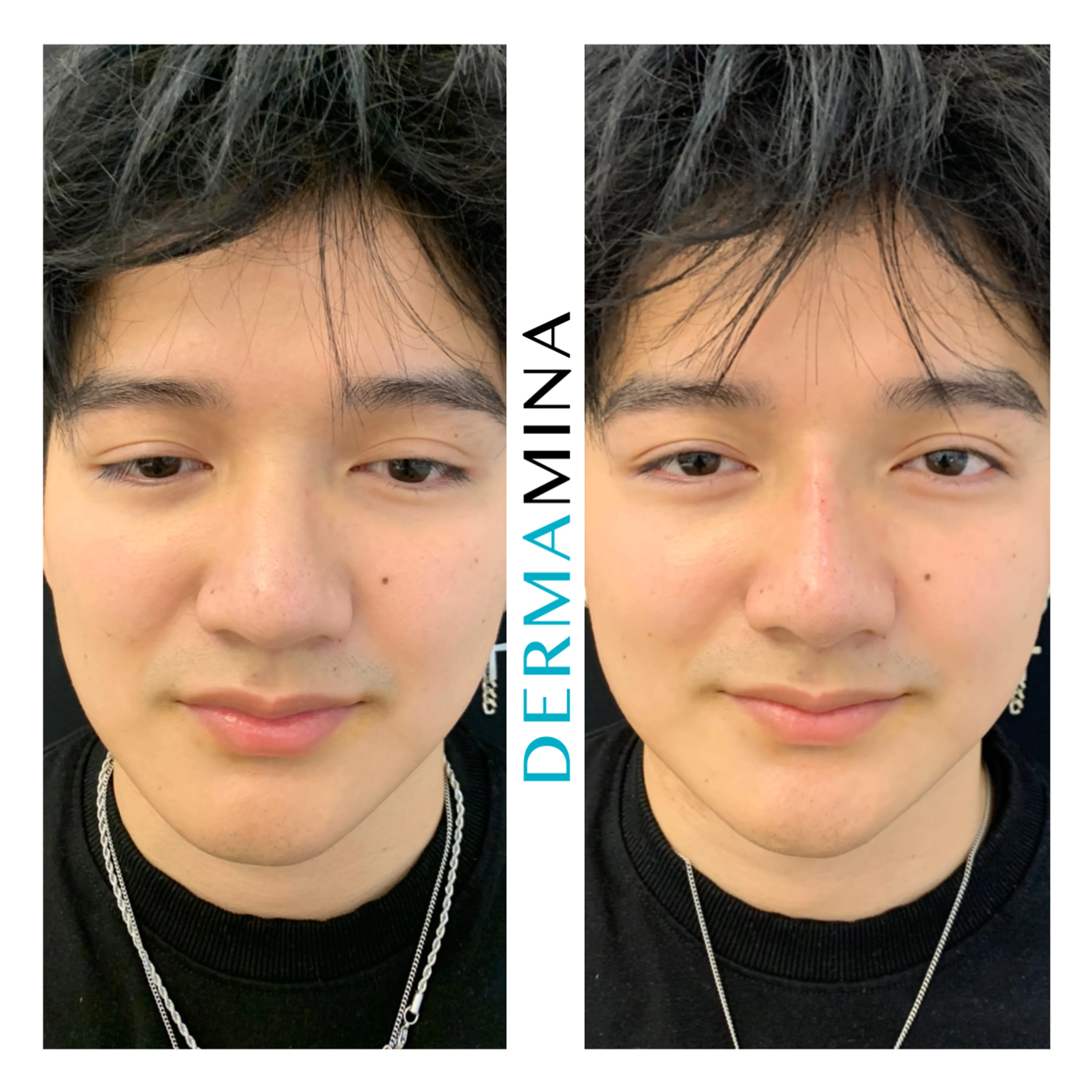 Non-surgical nose job before and after at Dermamina London, flat bridge built up and defined