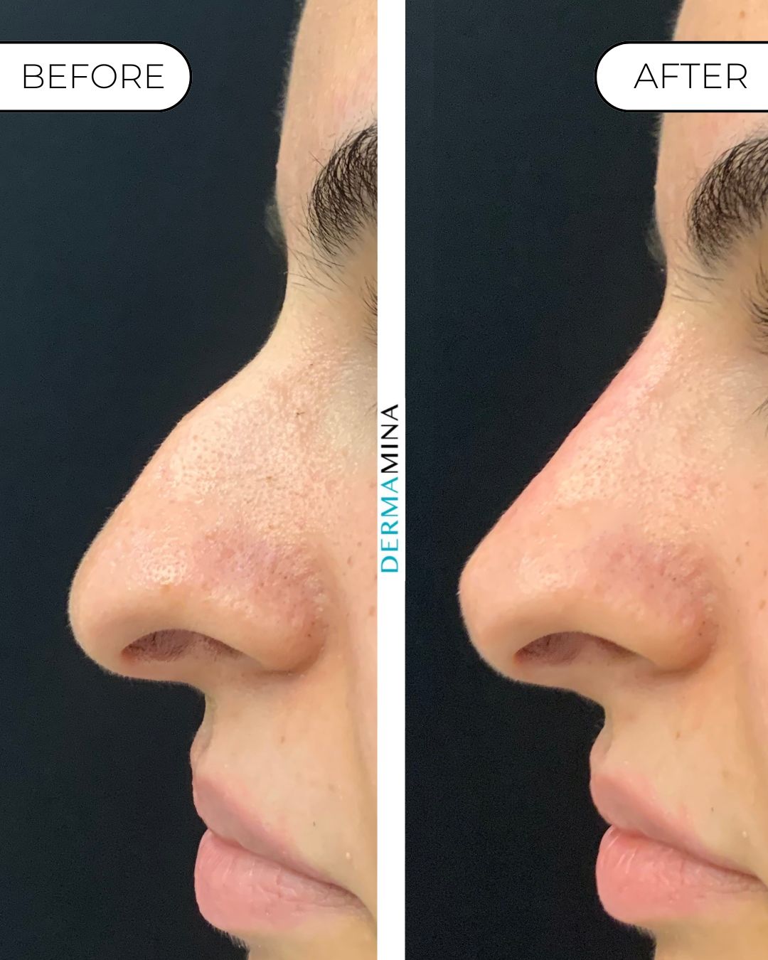 Non-surgical nose job before and after at Dermamina London, dorsal bump smoothed