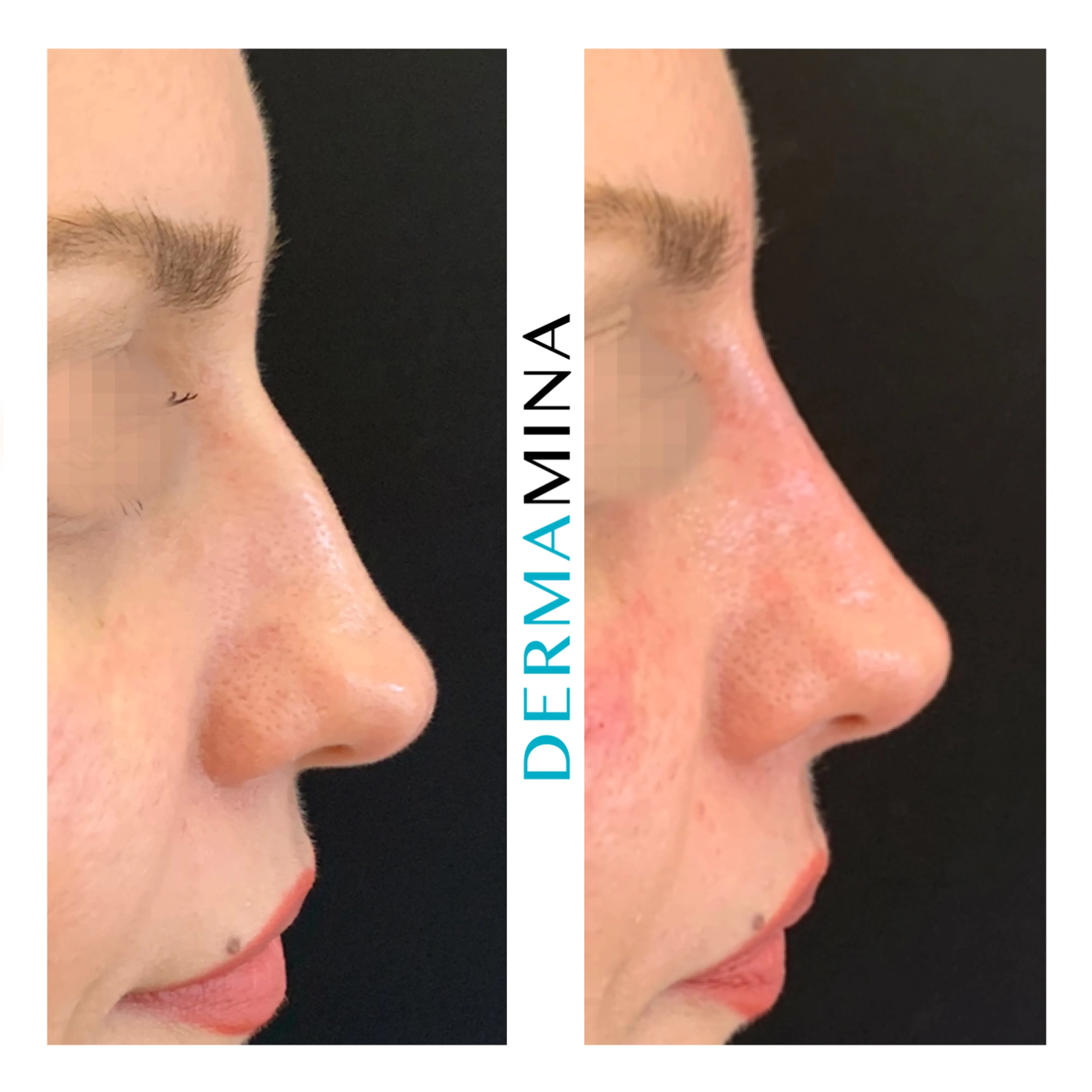 Non-surgical nose job before and after at Dermamina London, dorsal bump smoothed
