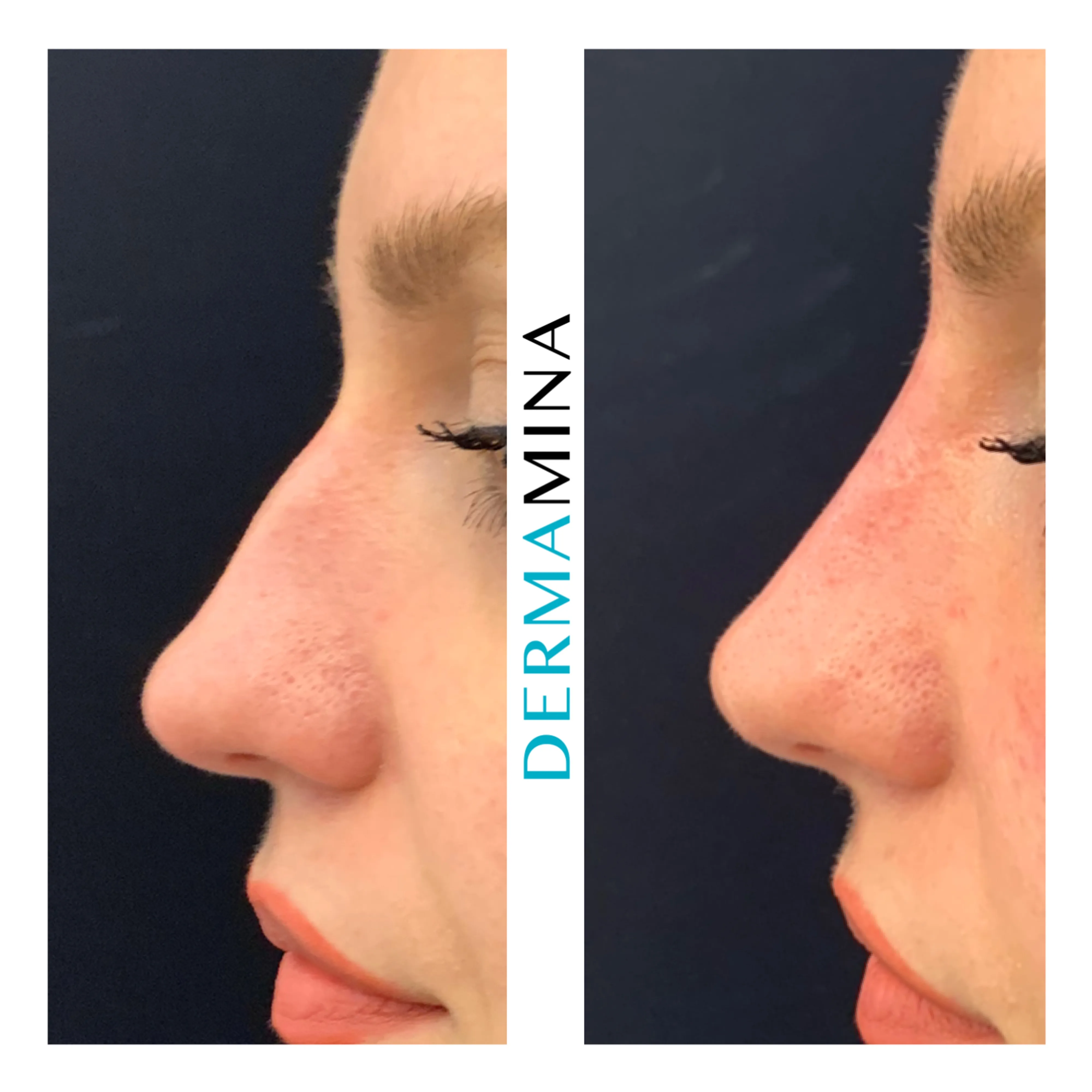 Non-surgical nose job before and after at Dermamina London, dorsal bump smoothed