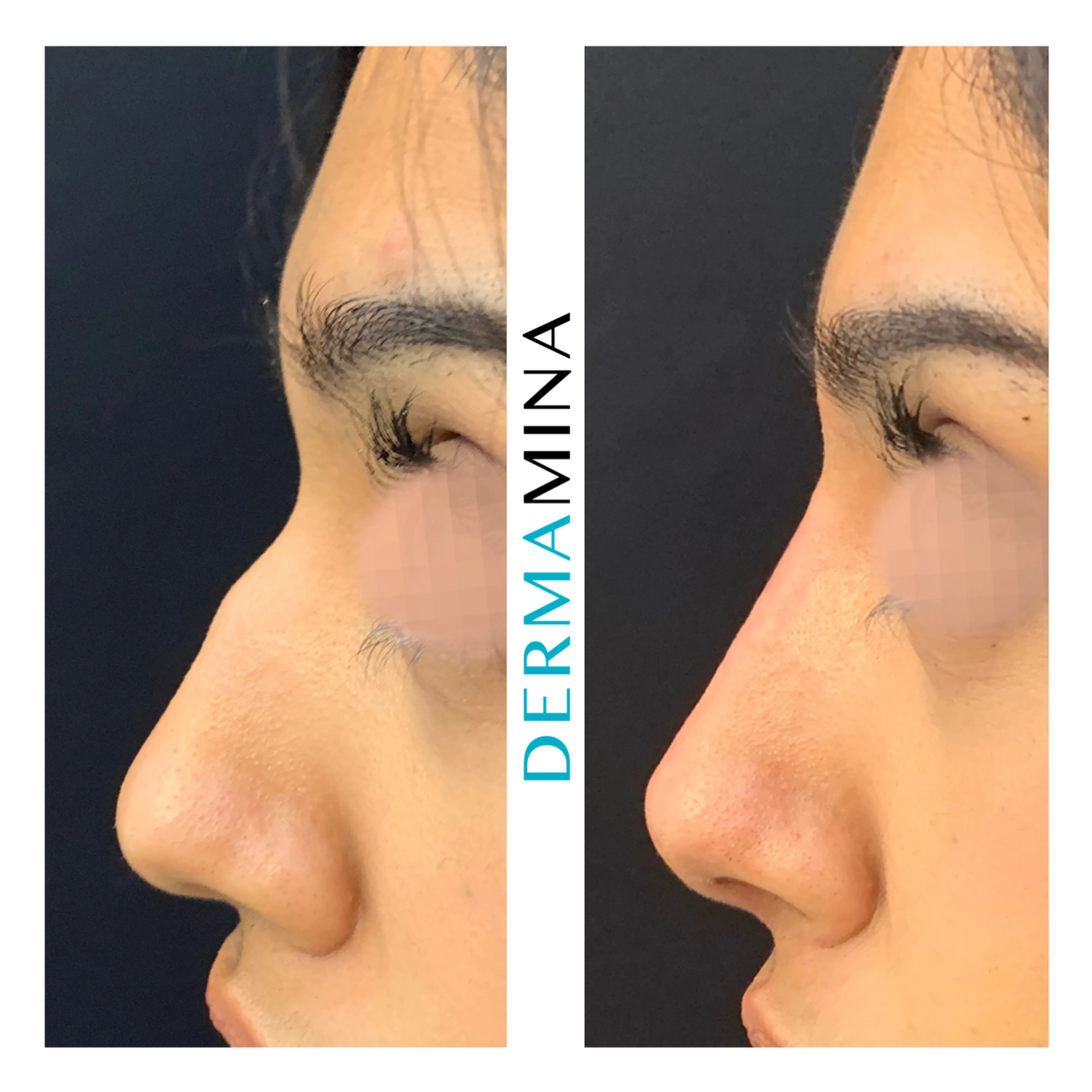 Non-surgical nose job before and after at Dermamina London, dorsal bump smoothed