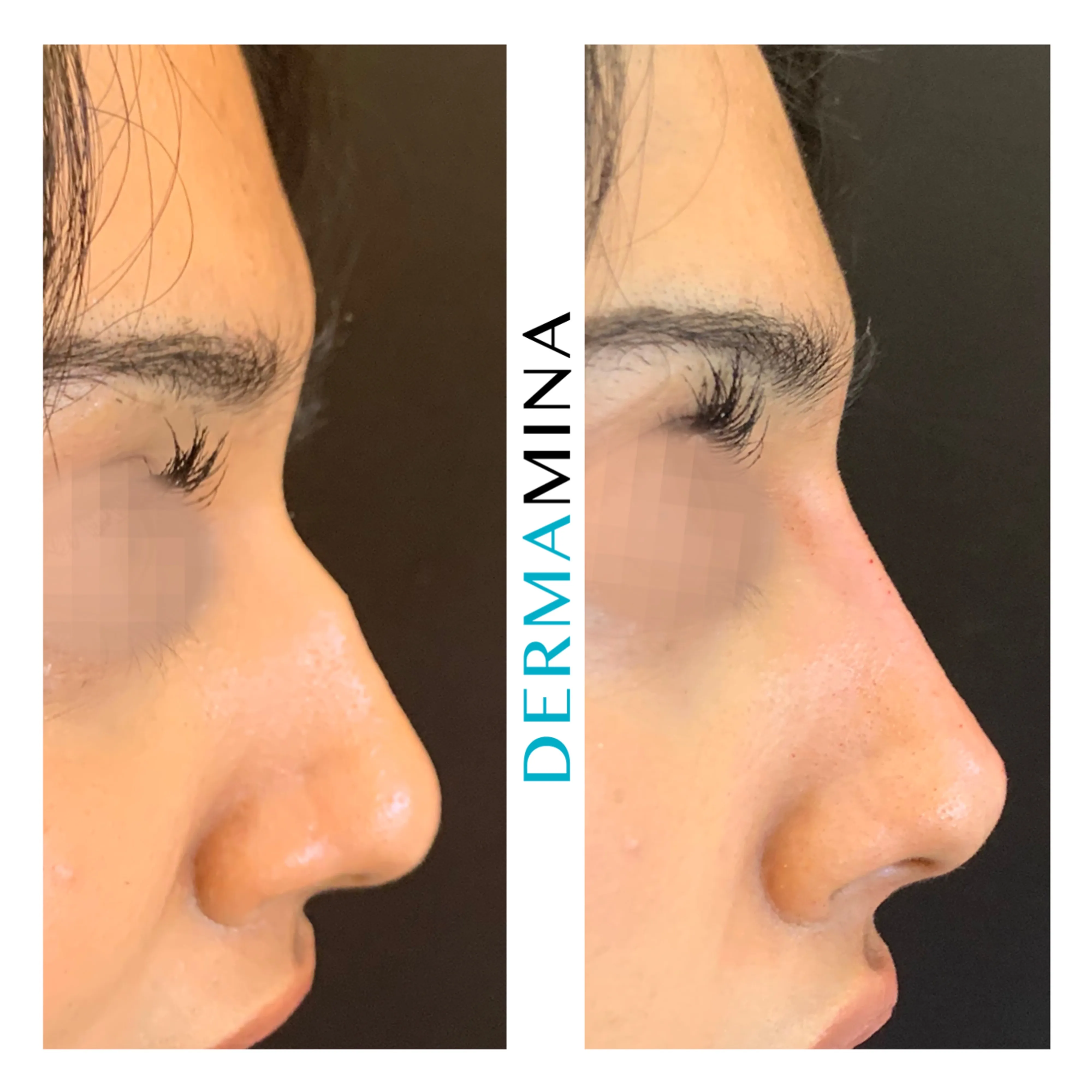 Non-surgical nose job before and after at Dermamina London, dorsal bump smoothed