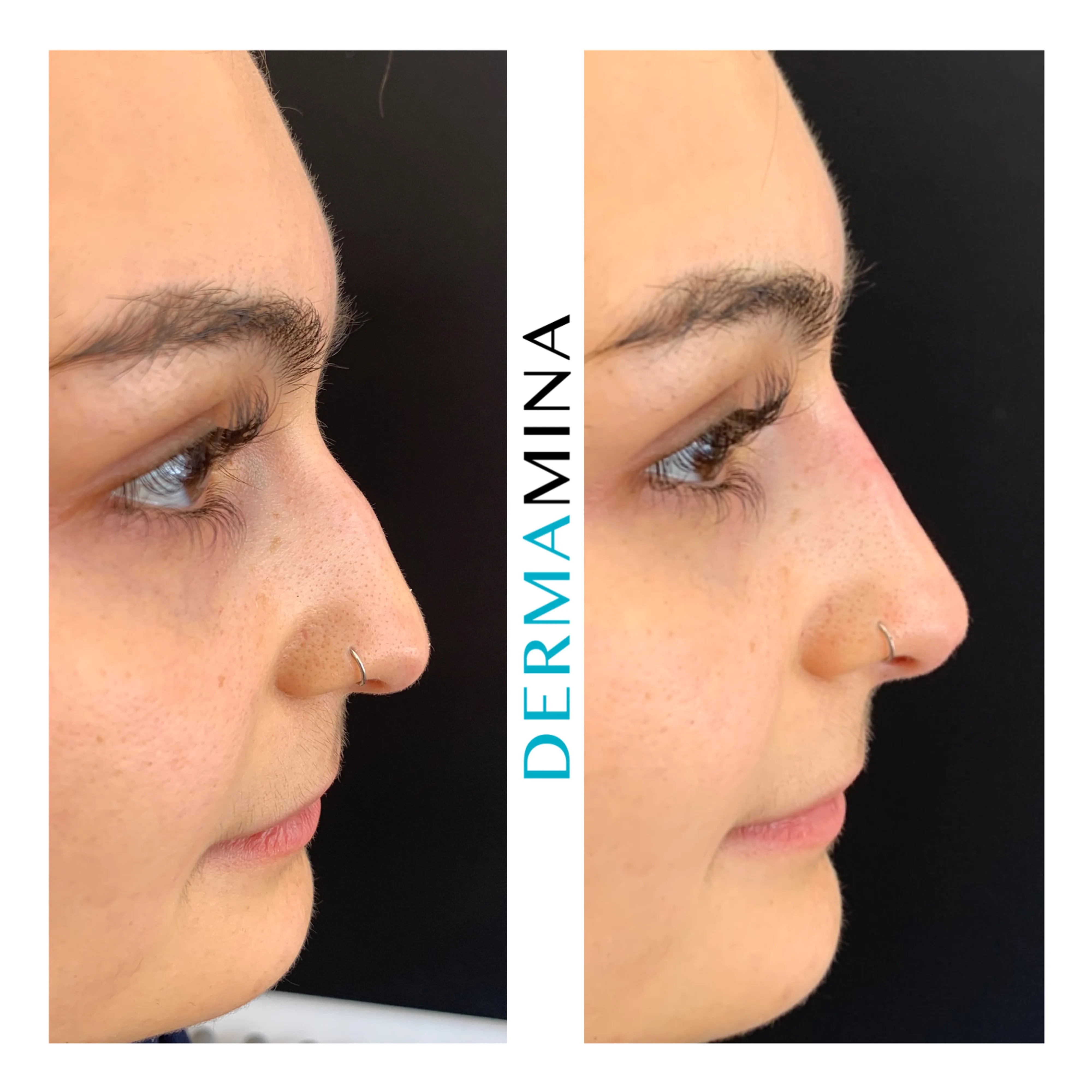 Non-surgical nose job before and after at Dermamina London, dorsal bump smoothed