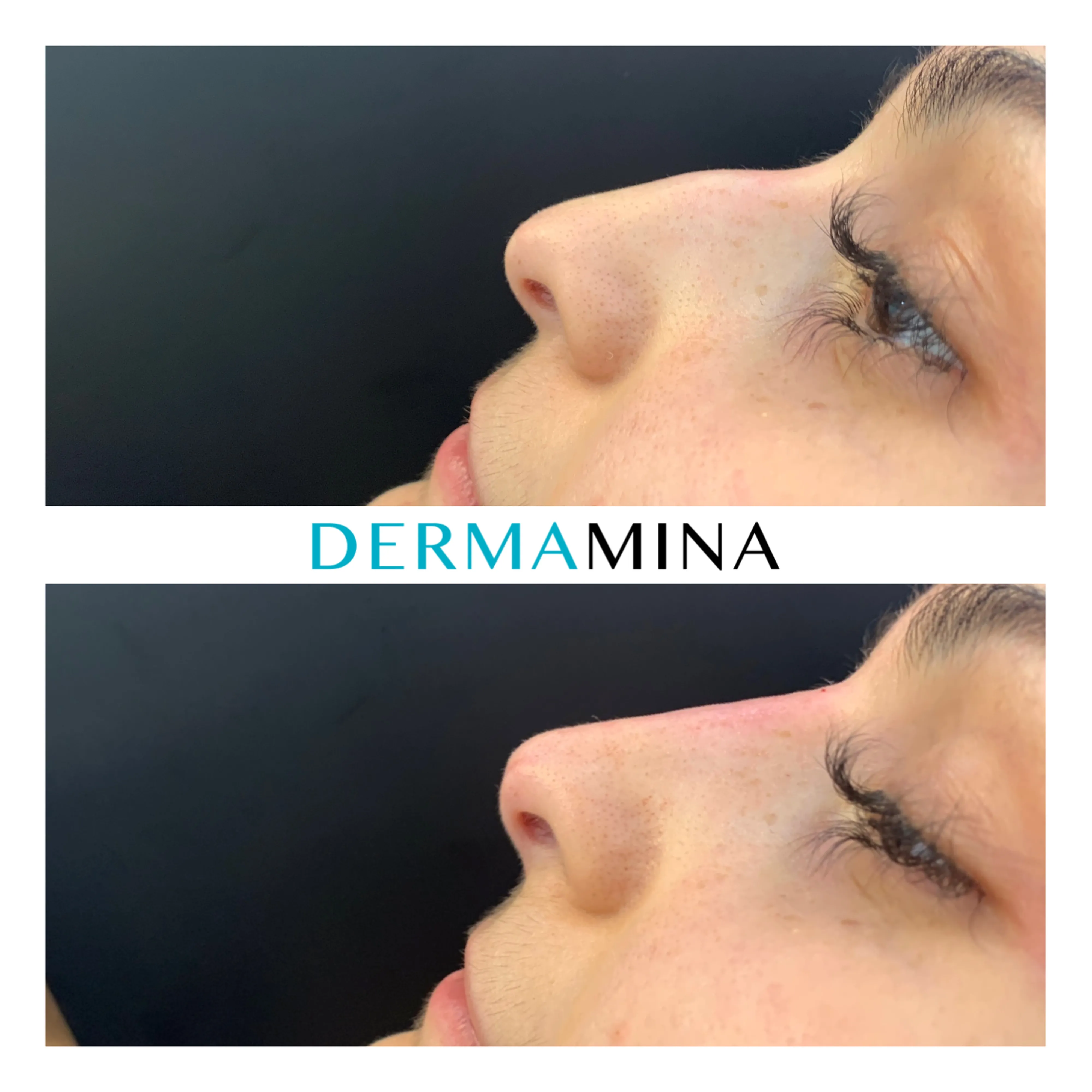 Non-surgical nose job before and after at Dermamina London, dorsal bump smoothed