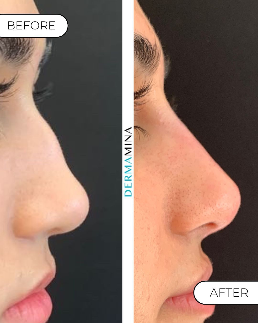 Non-surgical nose job before and after at Dermamina London, dorsal bump smoothed