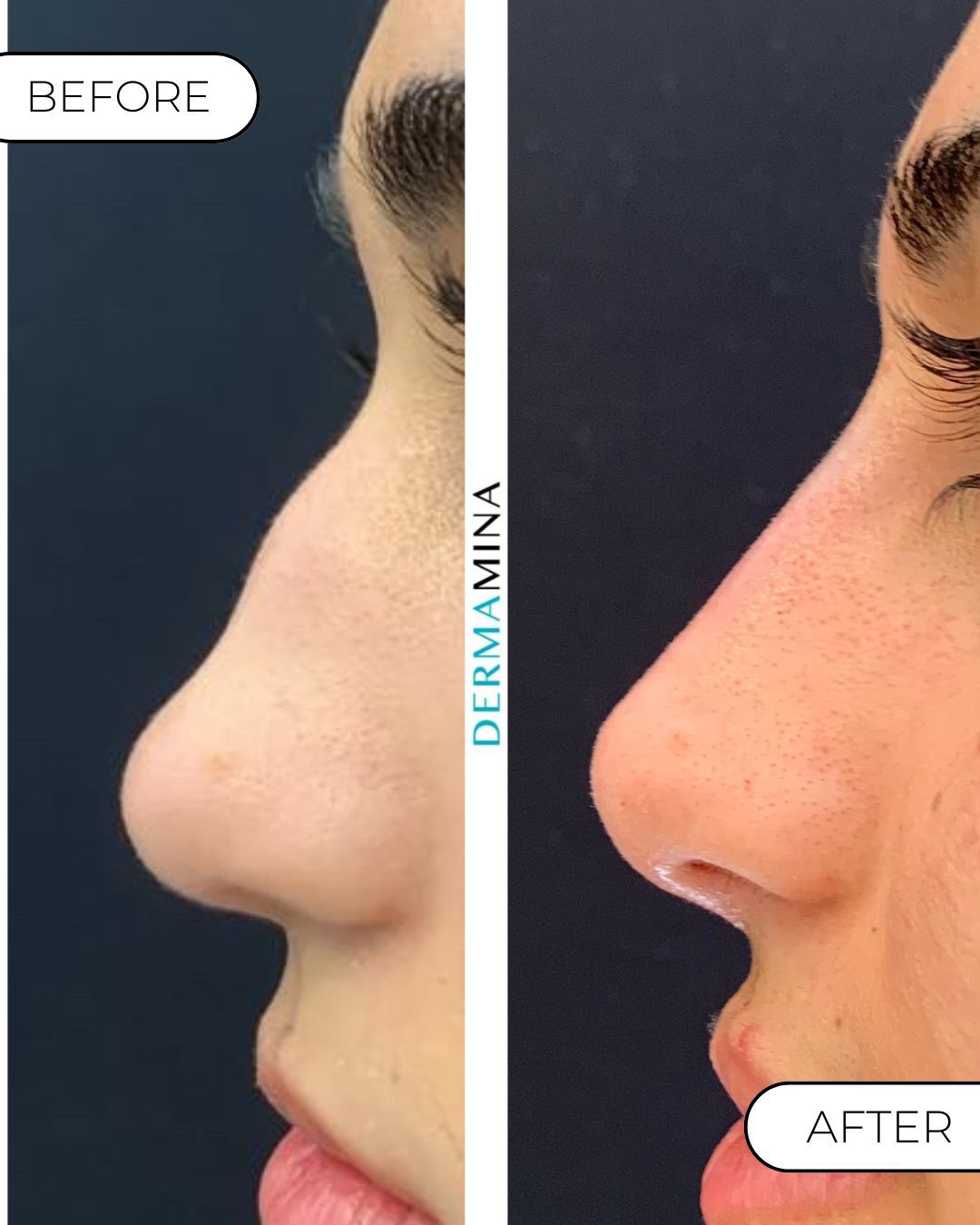 Non-surgical nose job before and after at Dermamina London, dorsal bump smoothed