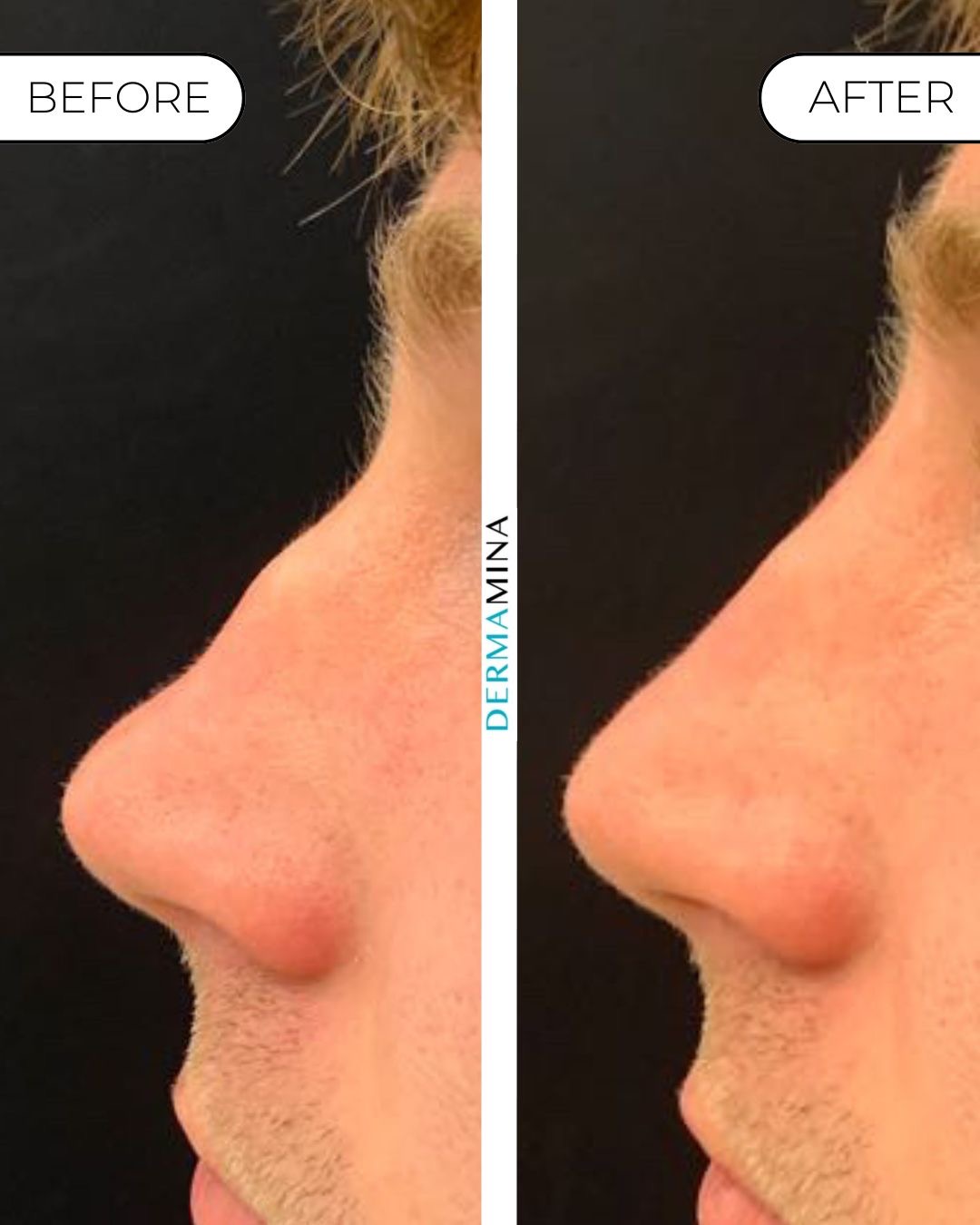 Non-surgical nose job before and after at Dermamina London, dorsal bump smoothed