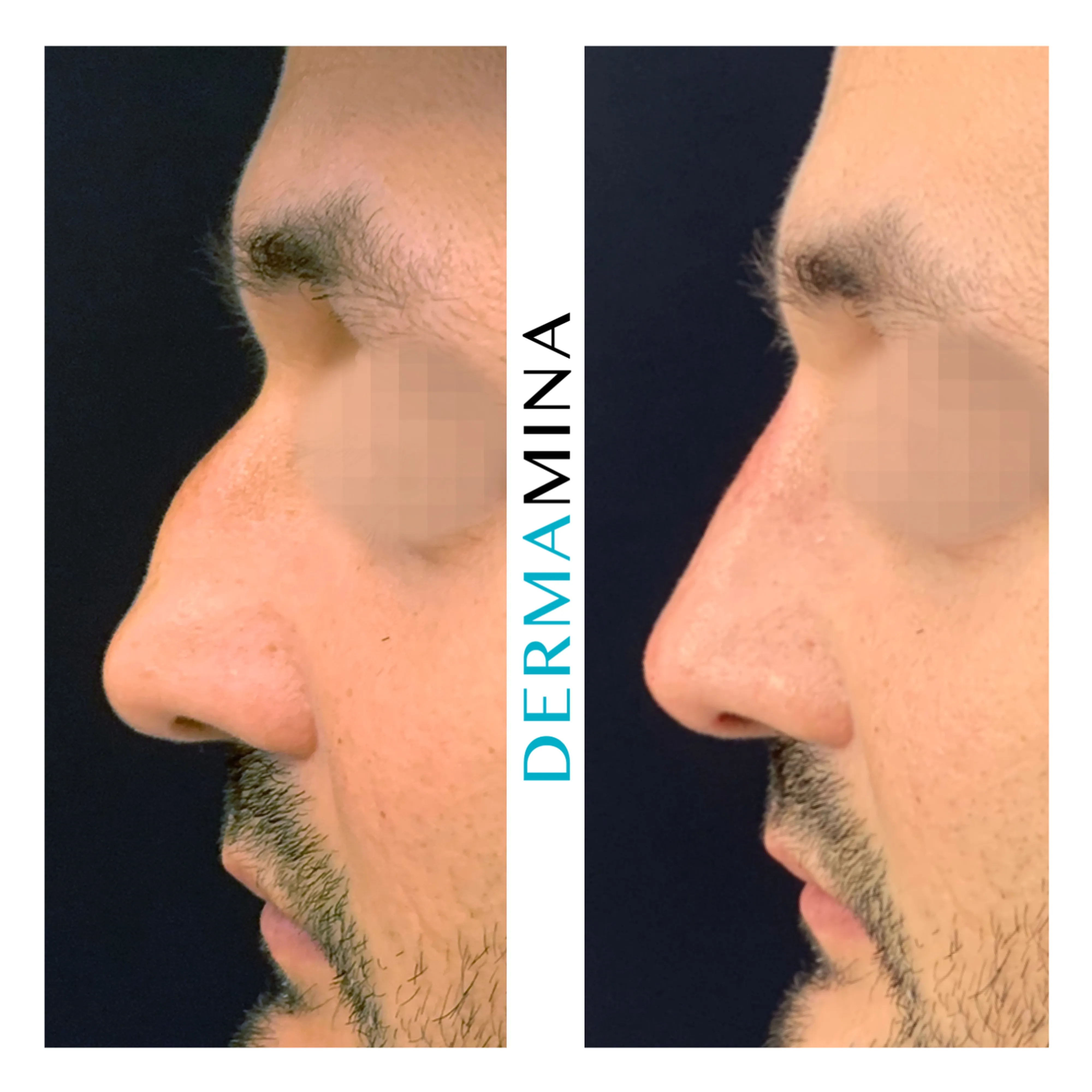 Non-surgical nose job before and after at Dermamina London, dorsal bump smoothed
