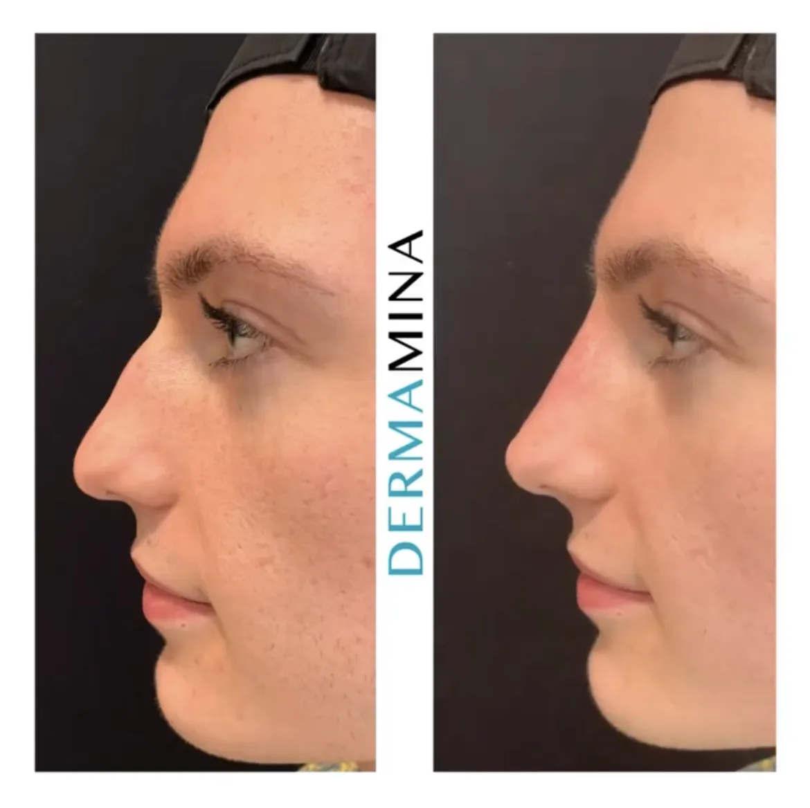 Non-surgical nose job before and after at Dermamina London, dorsal bump smoothed