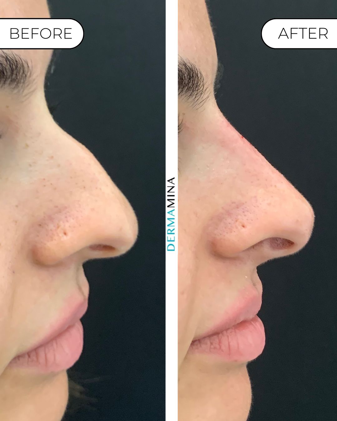 Non-surgical nose job before and after at Dermamina London, hooked profile straightened