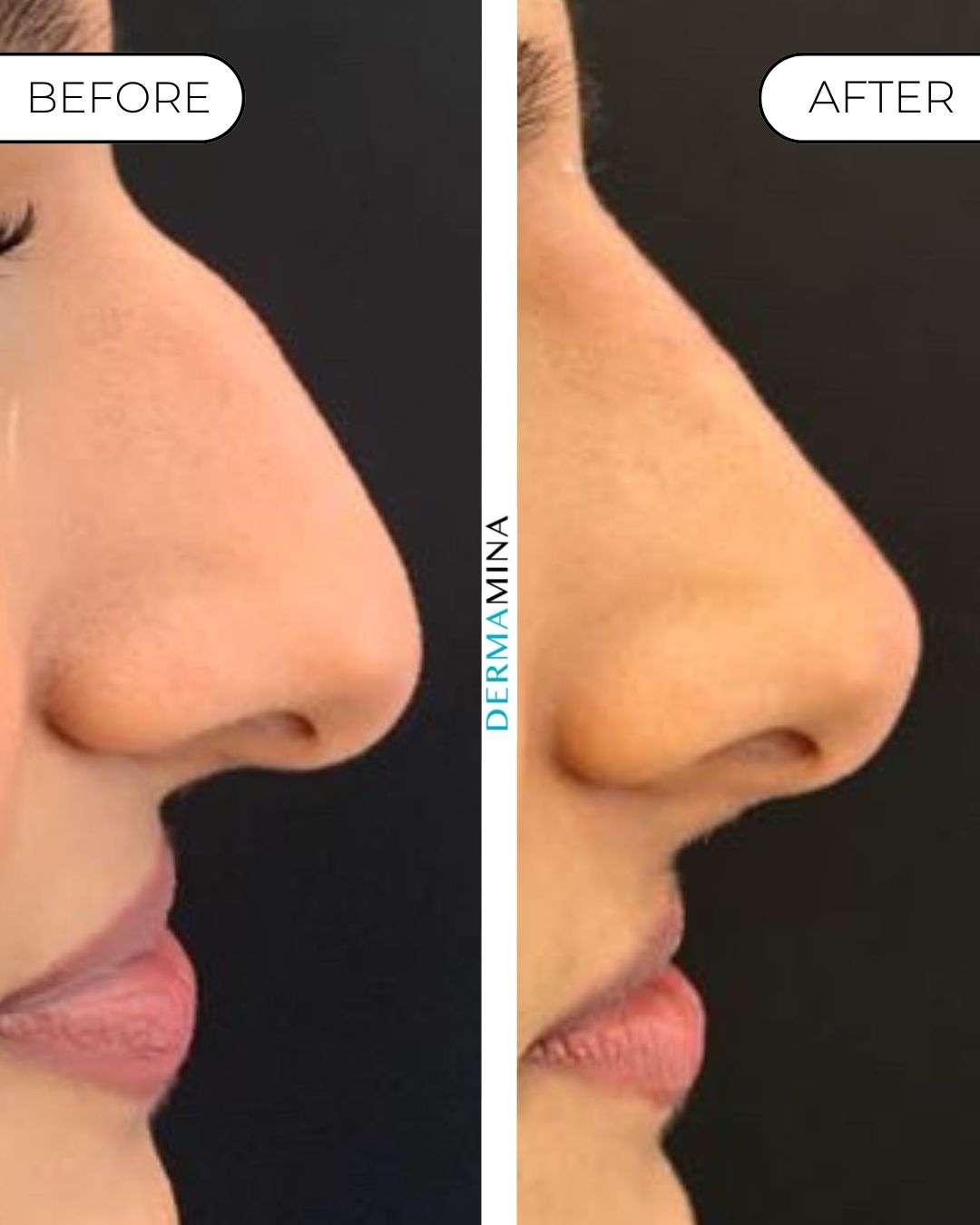 Non-surgical nose job before and after at Dermamina London, hooked profile straightened