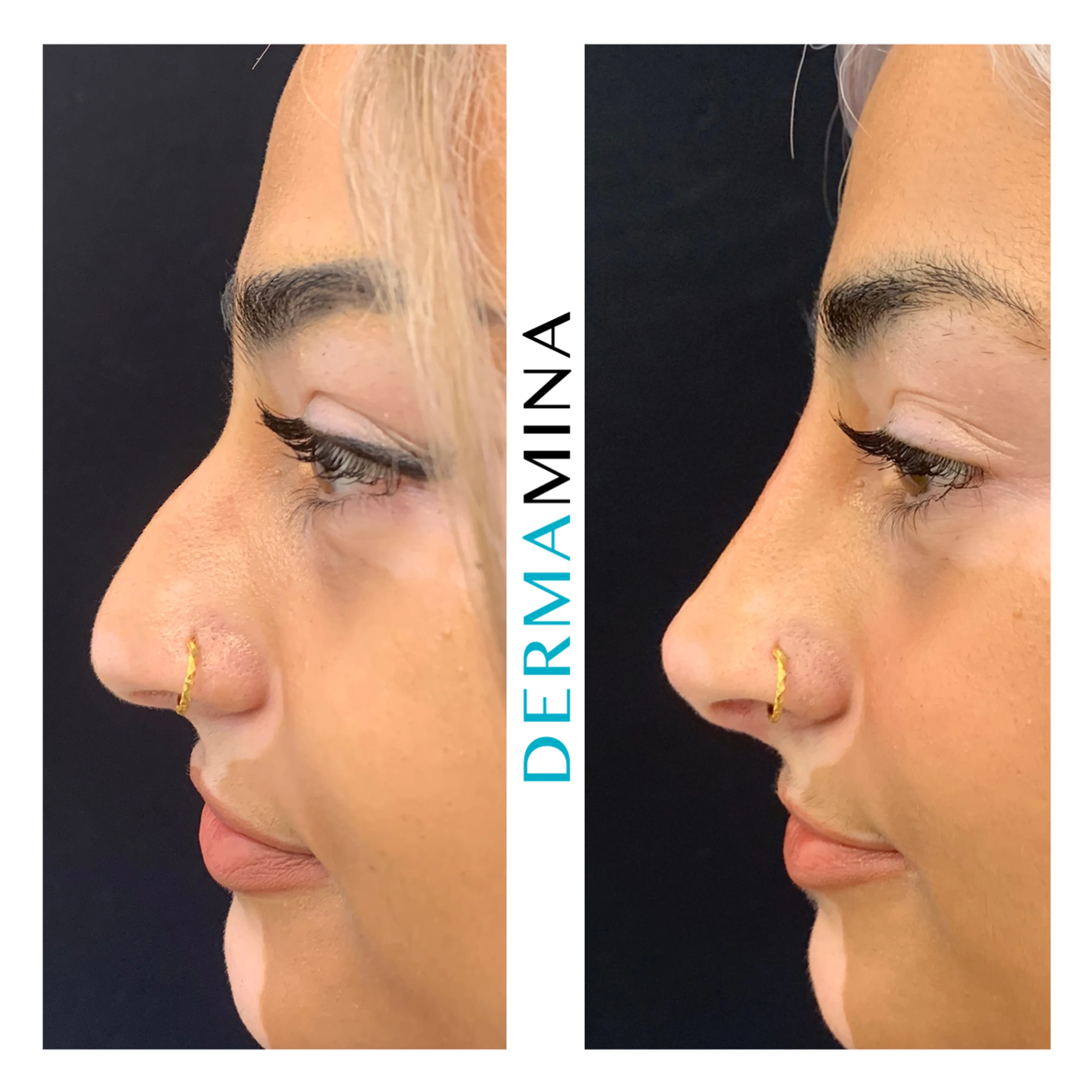 Non-surgical nose job before and after at Dermamina London, hooked profile straightened