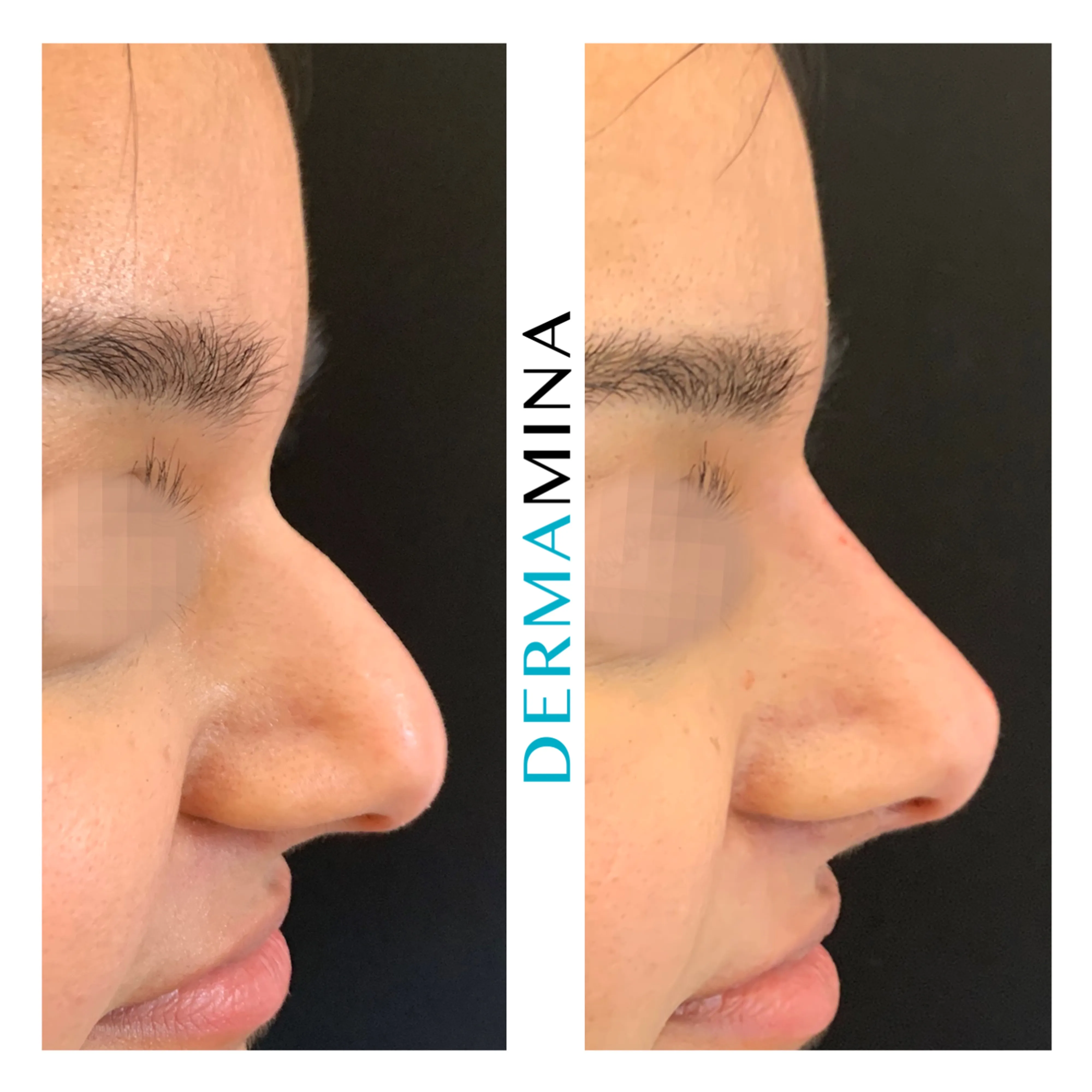 Non-surgical nose job before and after at Dermamina London, hooked profile straightened