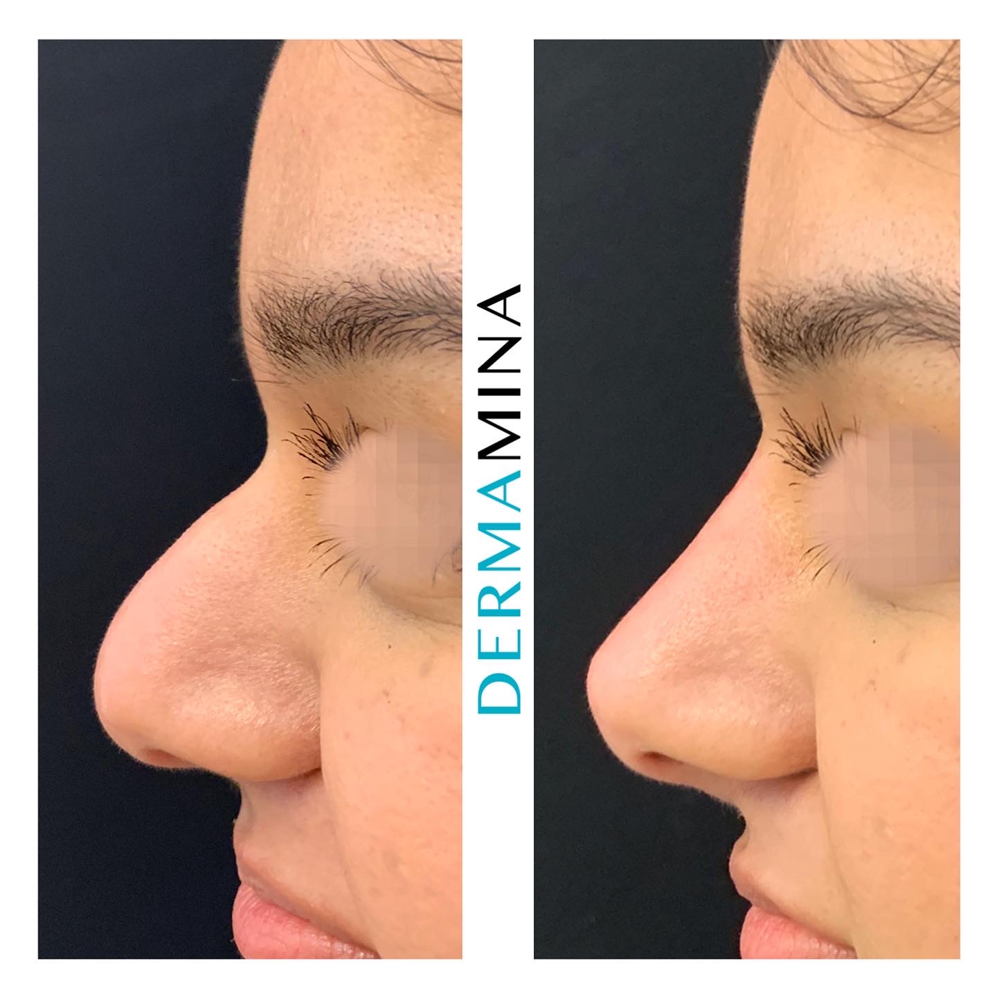 Non-surgical nose job before and after at Dermamina London, hooked profile straightened