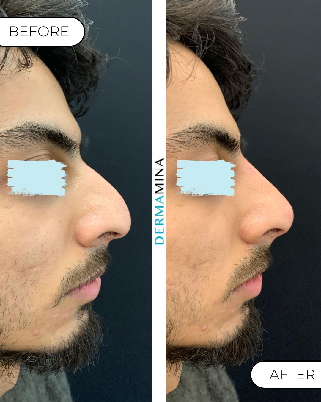 Non-surgical nose job before and after at Dermamina London, hooked profile straightened