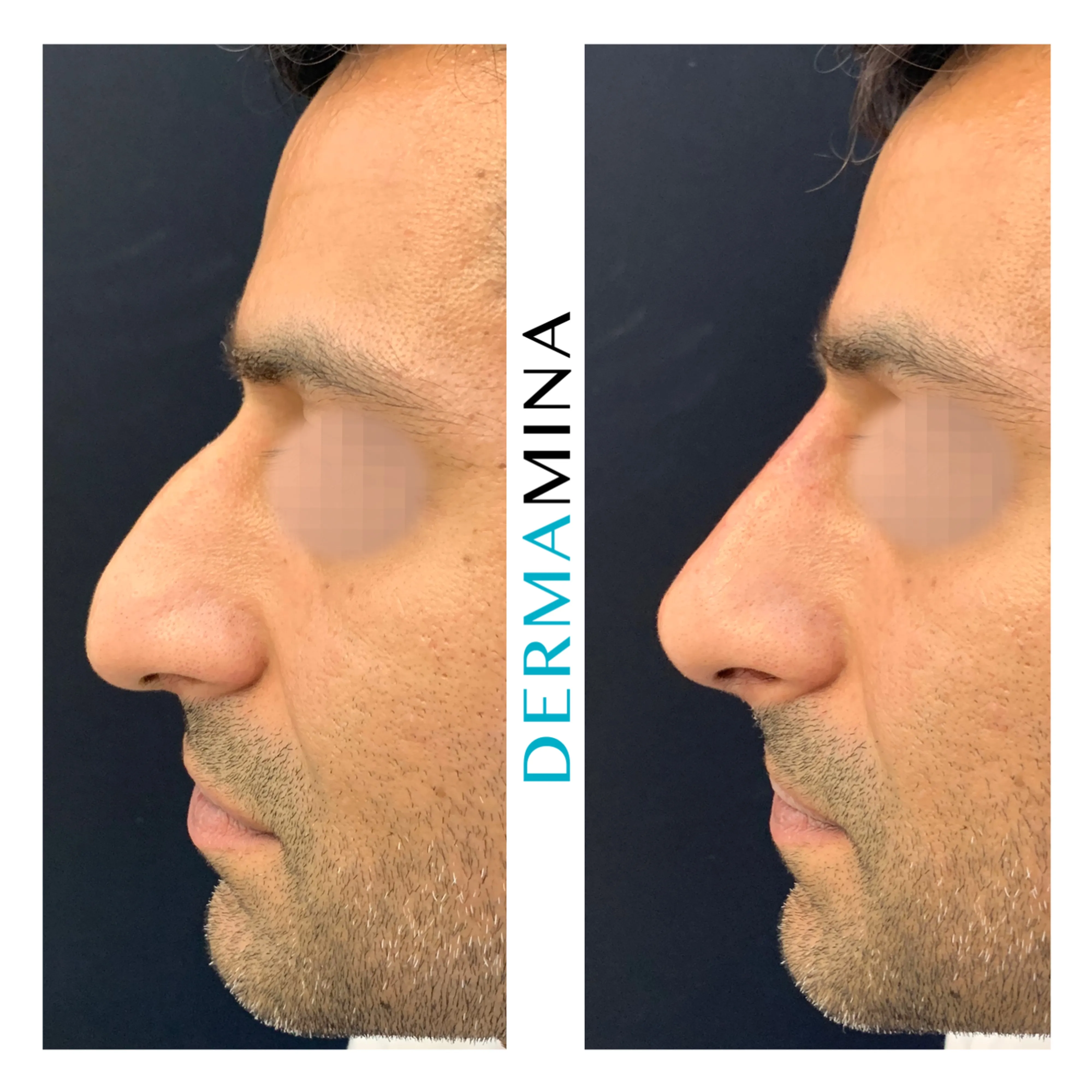 Non-surgical nose job before and after at Dermamina London, hooked profile straightened