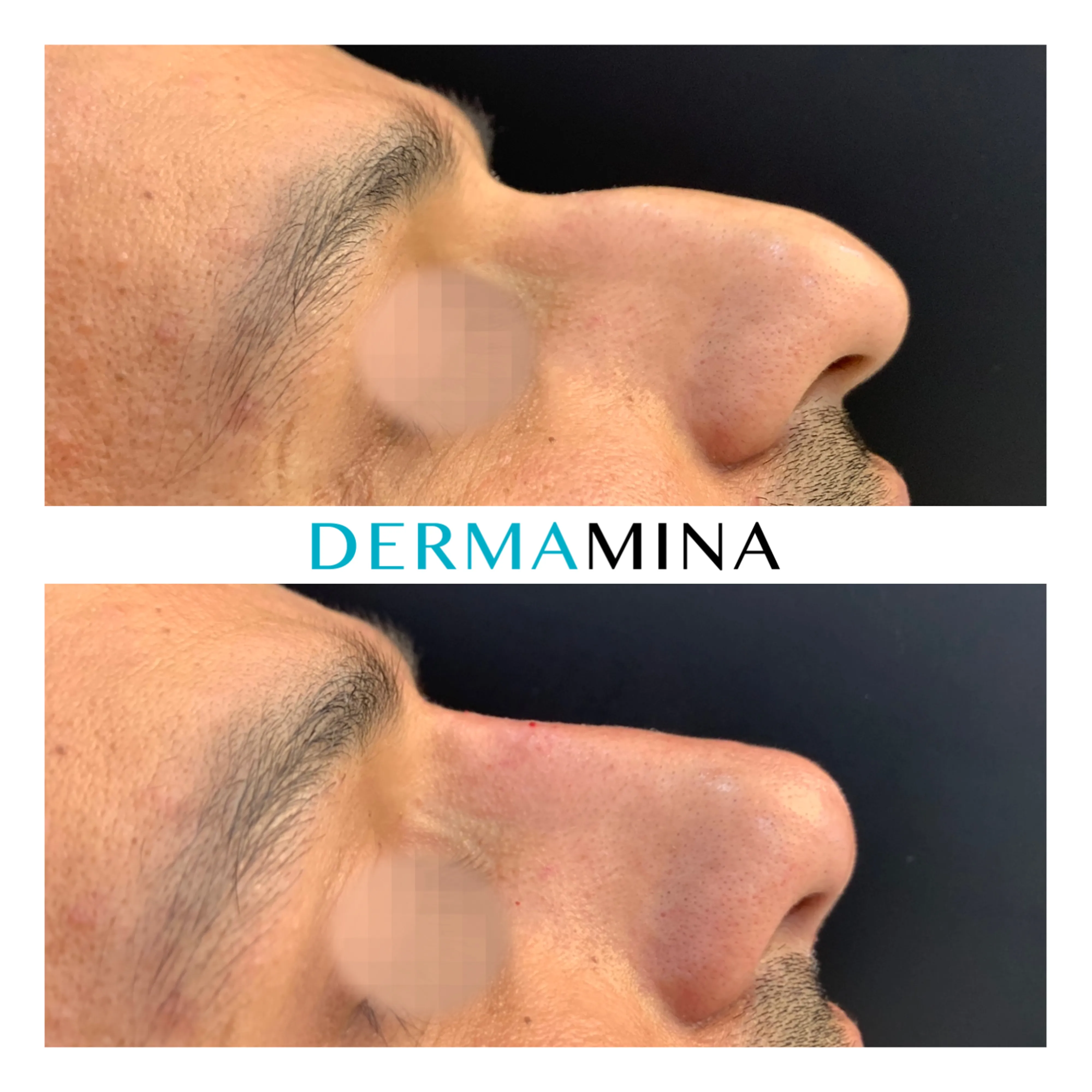 Non-surgical nose job before and after at Dermamina London, hooked profile straightened
